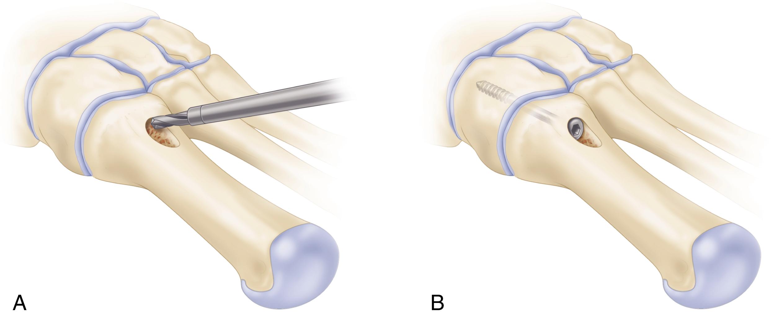 FIGURE 82.46, Screw hole preparation. A, Notch is made for passage of screw head. Drilling should begin near surface of bone, not in depths of notch. B, Screw head sits in untapered end of notch after passing through it. Joint or fusion surfaces remain well reduced. (From Manoli A, Hansen S: Screw hole preparation in foot surgery, Foot Ankle 11:105, 1990.) SEE TECHNIQUE 82.10.