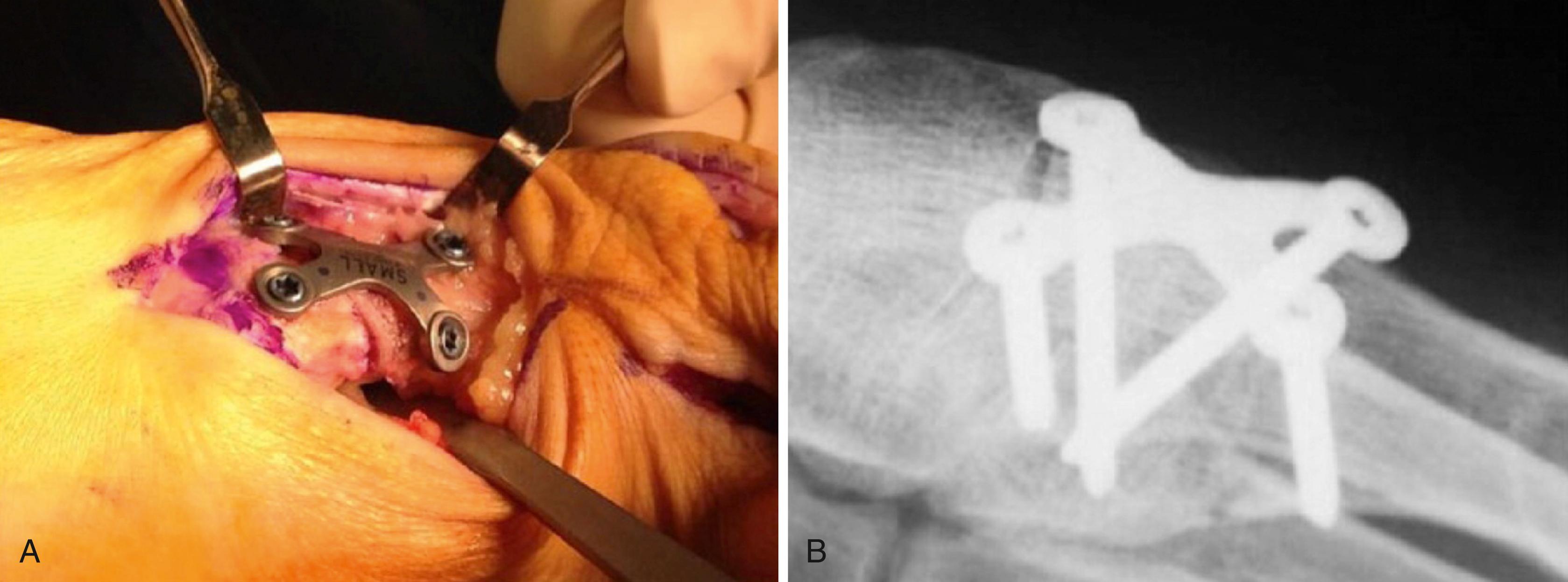 FIGURE 82.47, Clinical photo and radiograph of X-plate. (From Pauli W, Koch A, Testa E, et al: Fixation of the proximal metatarsal crescentic osteotomy using a head locking X-plate, Foot Ankle Int 37:218, 2016.) SEE TECHNIQUE 82.10.