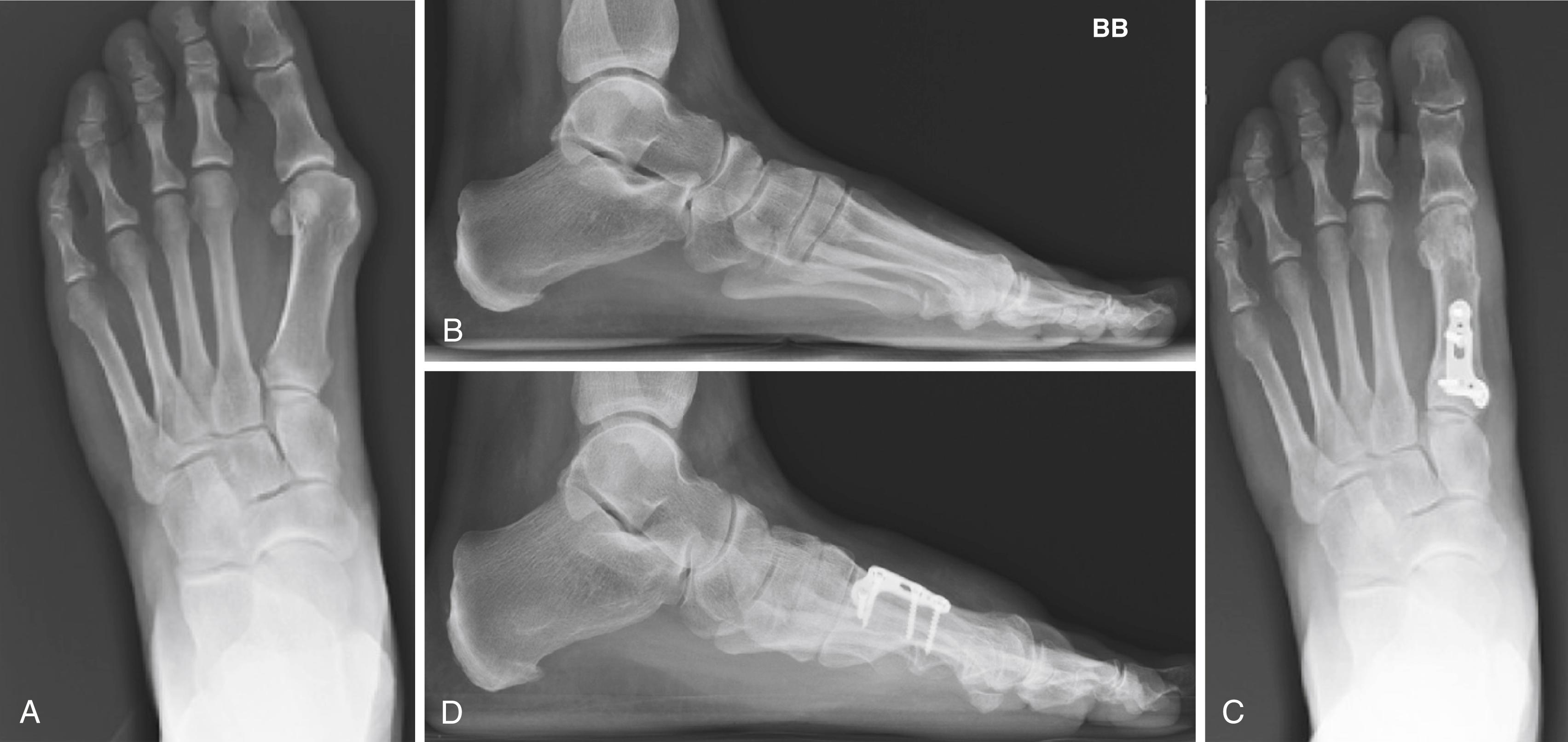 FIGURE 82.43, A and B, Anteroposterior and lateral views of severe hallux valgus. C and D, Postoperative anteroposterior and lateral radiographs 1 year after first metatarsal proximal crescentic and Akin osteotomies, showing maintained deformity correction.