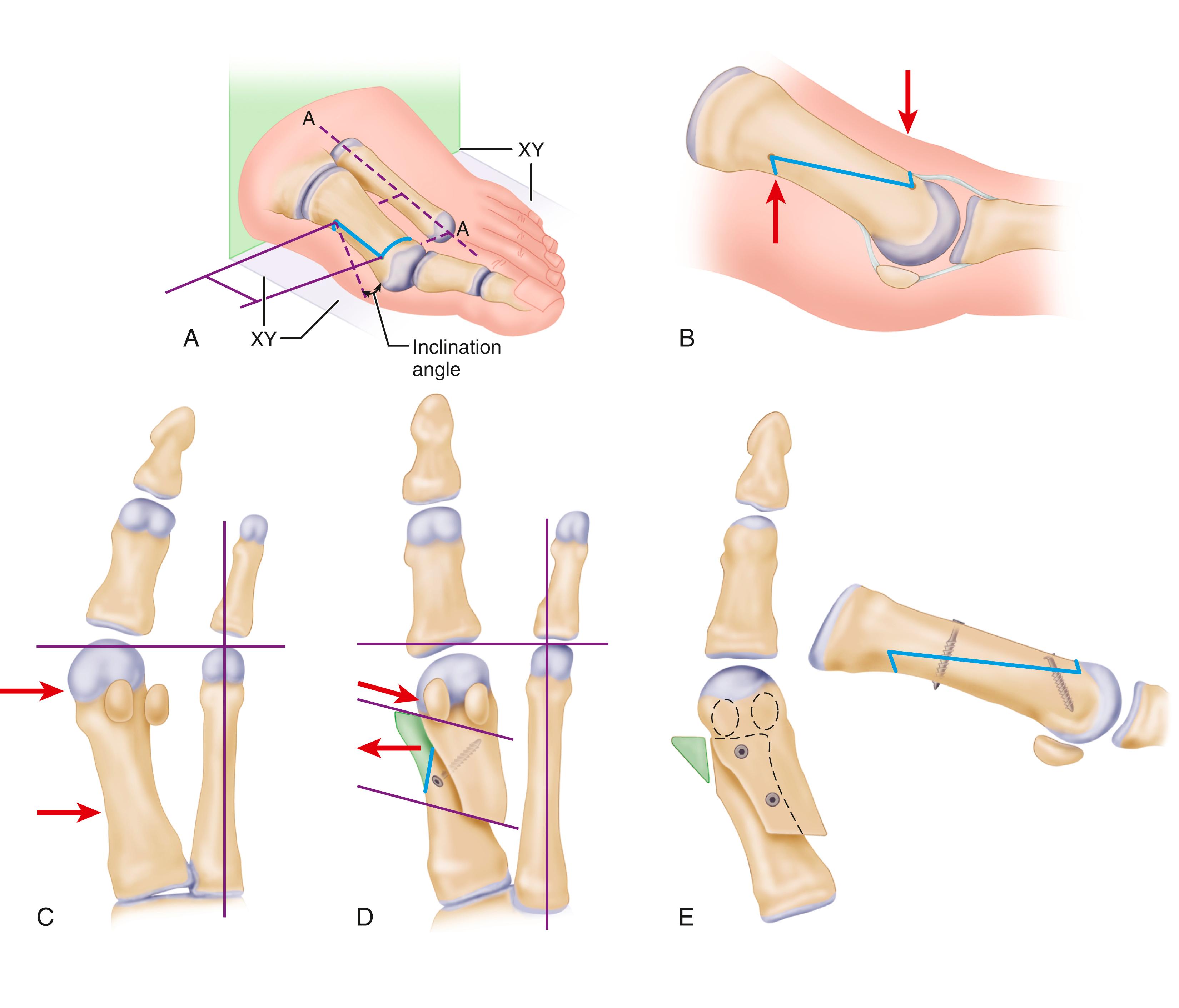 FIGURE 82.48, Scarf osteotomy. A, Placement of Kirschner wires at corner point of planned osteotomy. Standard orientation for lateral translation is 90 degrees to longitudinal axis of second metatarsal (A) and in approximately 20 degrees horizontal inclination to plantar surface (XY). B, Osteotomy cuts. C, Lateral displacement is obtained if short osteotomy cuts are perpendicular to longitudinal axis of foot. D, Proximally oriented inclination of short osteotomy cuts caused shortening depending on angle of inclination and amount of translation. E, After lateral displacement, osteotomy is fixed with two minifragment screws. ( A - D redrawn from Kristen KH, Berger C, Stelzig S, et al: The scarf osteotomy for the correction of hallux valgus deformities, Foot Ankle Int 23:221, 2002; E redrawn from Jones S, Al Hussainy HA, Ali F, et al: Scarf osteotomy for hallux valgus: a prospective clinical and pedobarographic study, J Bone Joint Surg 86B:830, 2004. Copyright British Editorial Society of Bone and Joint Surgery.) SEE TECHNIQUE 82.11 .