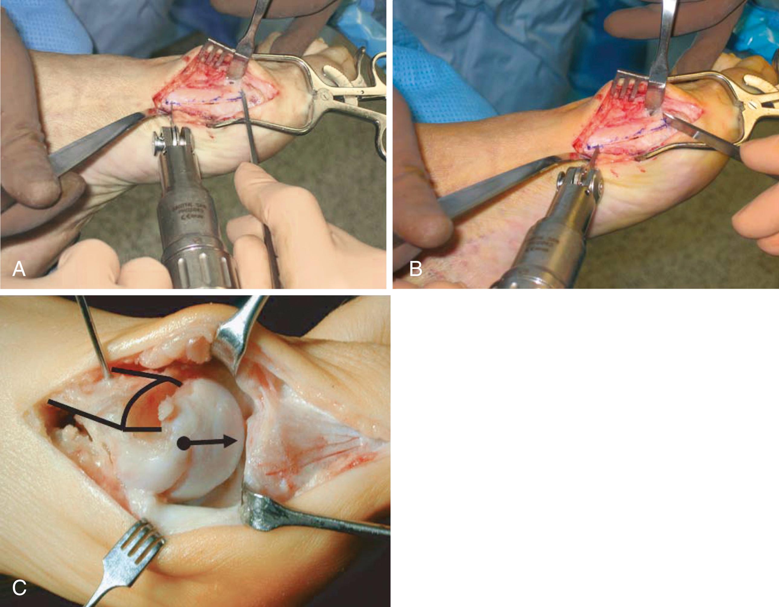 FIGURE 82.49, Scarf osteotomy. A, Two short arms of Z-cut should be perfectly parallel to allow capital fragment to displace laterally. To lengthen metatarsal, both short arms should project from medioproximal to laterodistal and remain parallel. B, If short arms converge, osteotomy is impossible to displace laterally. C, With short arms of Z parallel, capital fragment is easily displaced laterally. (From Coetzee JC, Rippstein P: Surgical strategies: scarf osteotomy for hallux valgus, Foot Ankle Int 28:529, 2007.) SEE TECHNIQUE 82.11 .