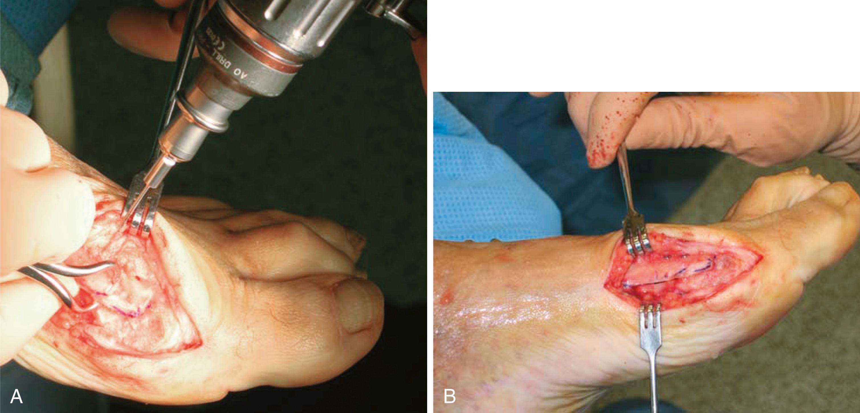 FIGURE 82.50, Scarf osteotomy. A, Capital fragment is displaced laterally while proximal fragment is held with clamp. Osteotomy is temporarily stabilized with Kirschner wire. B, Two screws are used to securely stabilize osteotomy. (From Coetzee JC, Rippstein P: Surgical strategies: scarf osteotomy for hallux valgus, Foot Ankle Int 28:529, 2007.) SEE TECHNIQUE 82.11 .