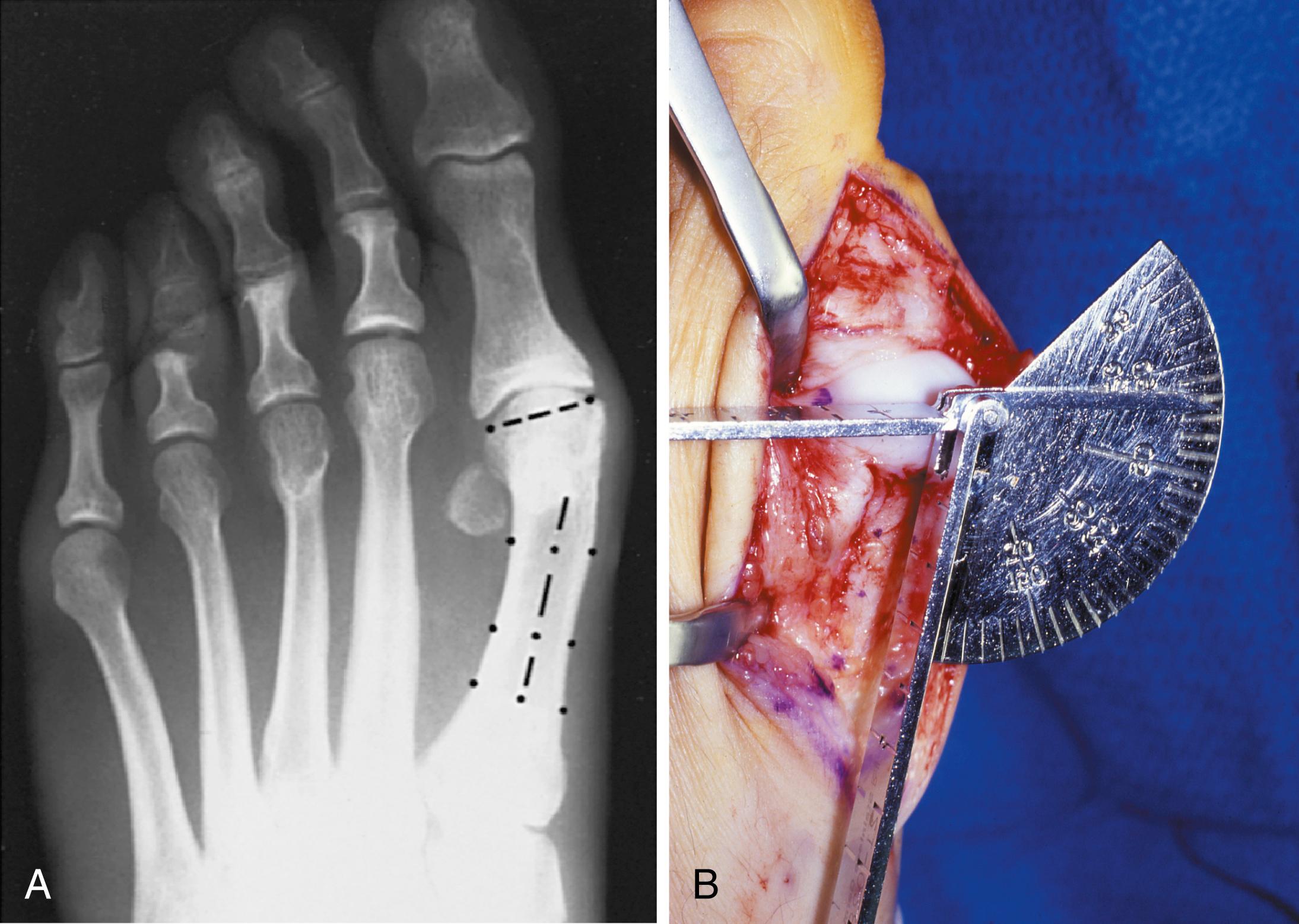 FIGURE 82.5, A, Determination of position of articular surface of metatarsal head in relation to longitudinal axis of first metatarsal. B, Measurement of distal metatarsal articular angle at time of surgery. Markings are at medial and lateral margins of articular surface of first metatarsal head and longitudinal axis of first metatarsal shaft.