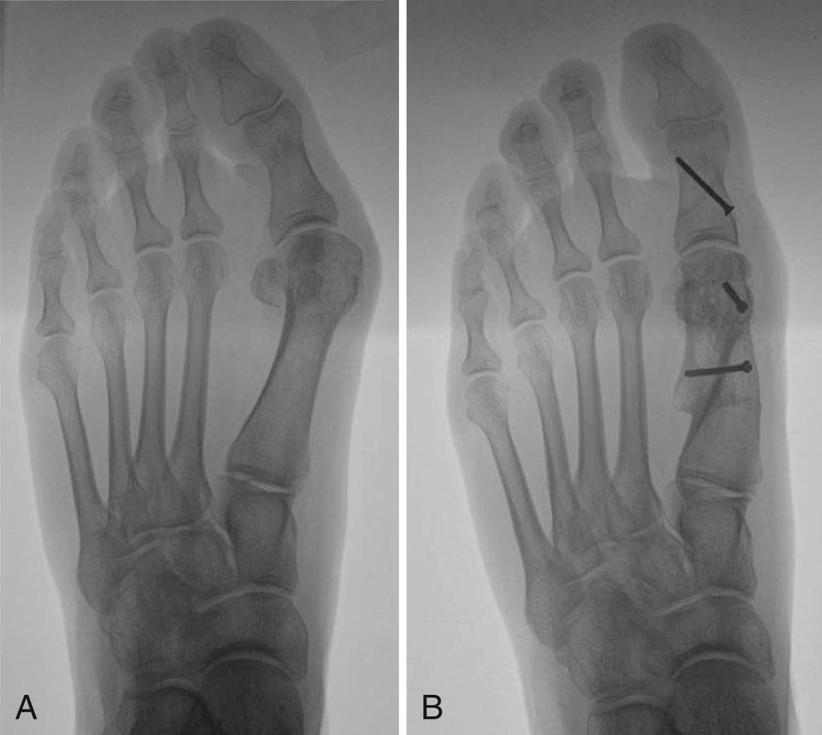 FIGURE 82.51, A, Patient with moderate metatarsus primus varus and hallux valgus deformity. B, Both intermetatarsal angle and hallux valgus are corrected; Akin osteotomy also was done to obtain complete correction of hallux valgus. (From Coetzee JC, Rippstein P: Surgical strategies: scarf osteotomy for hallux valgus, Foot Ankle Int 28:529, 2007.) SEE TECHNIQUE 82.11 .