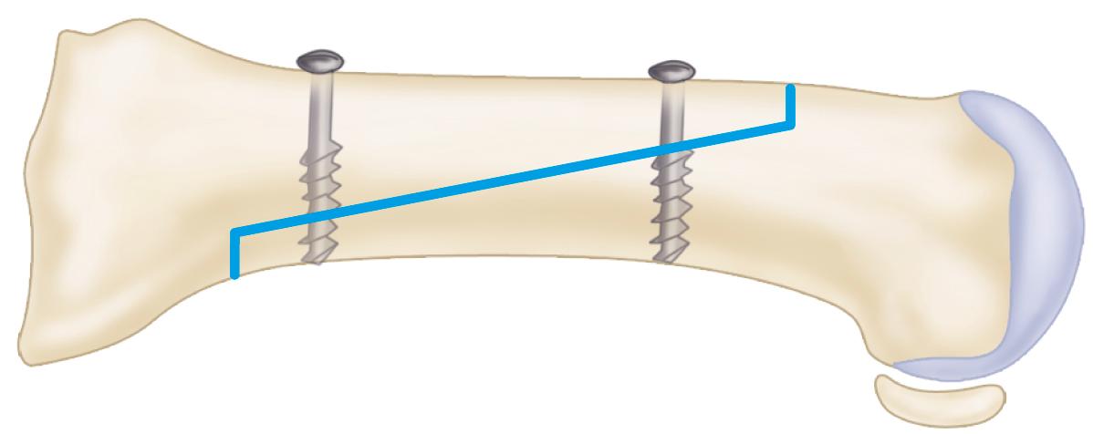 FIGURE 82.52, Shortening depth of short arms of Z osteotomy limits amount of metatarsal collapse, avoiding “troughing.”