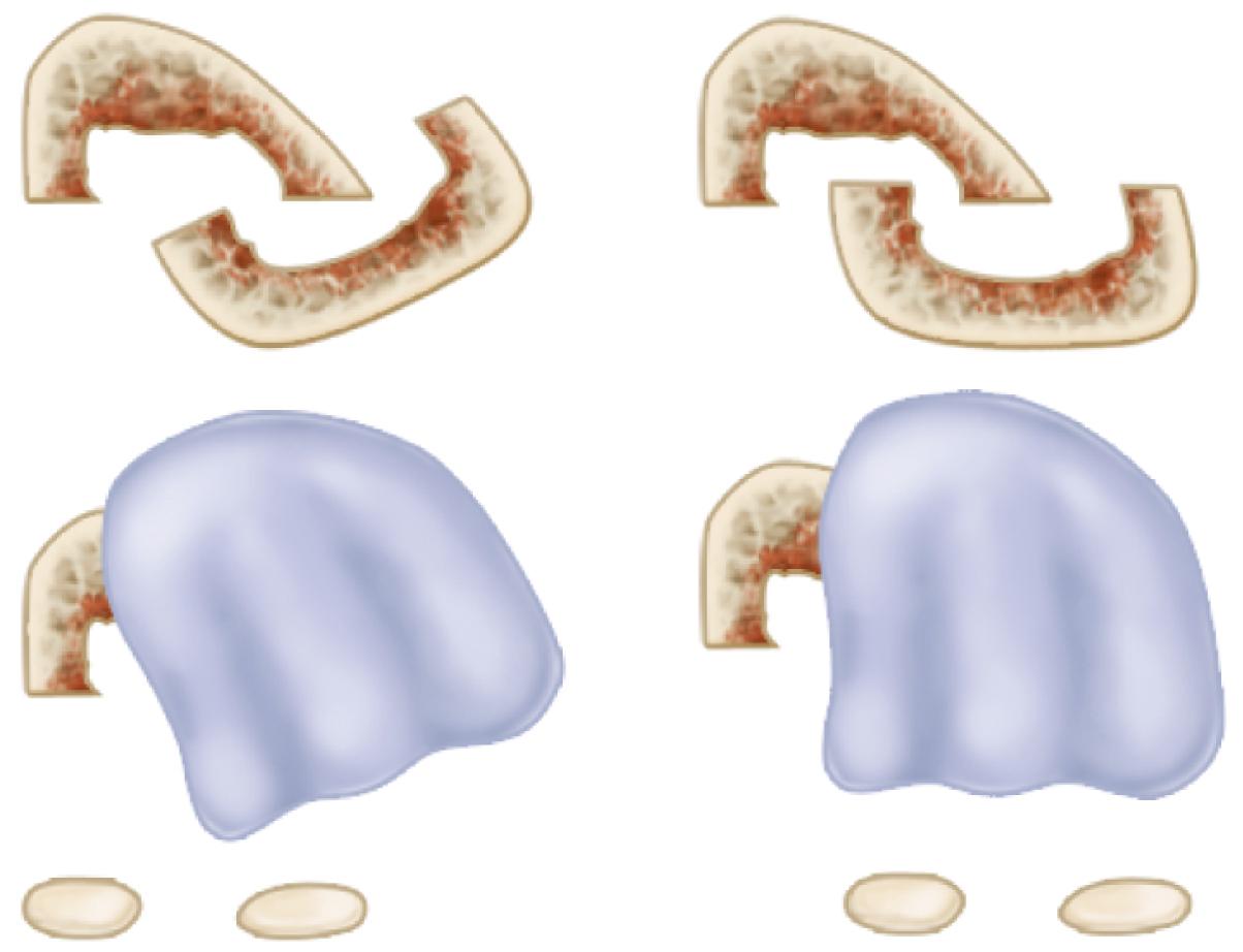 FIGURE 82.53, Troughing can lead to functional elevation of the first ray or rotational malunion.