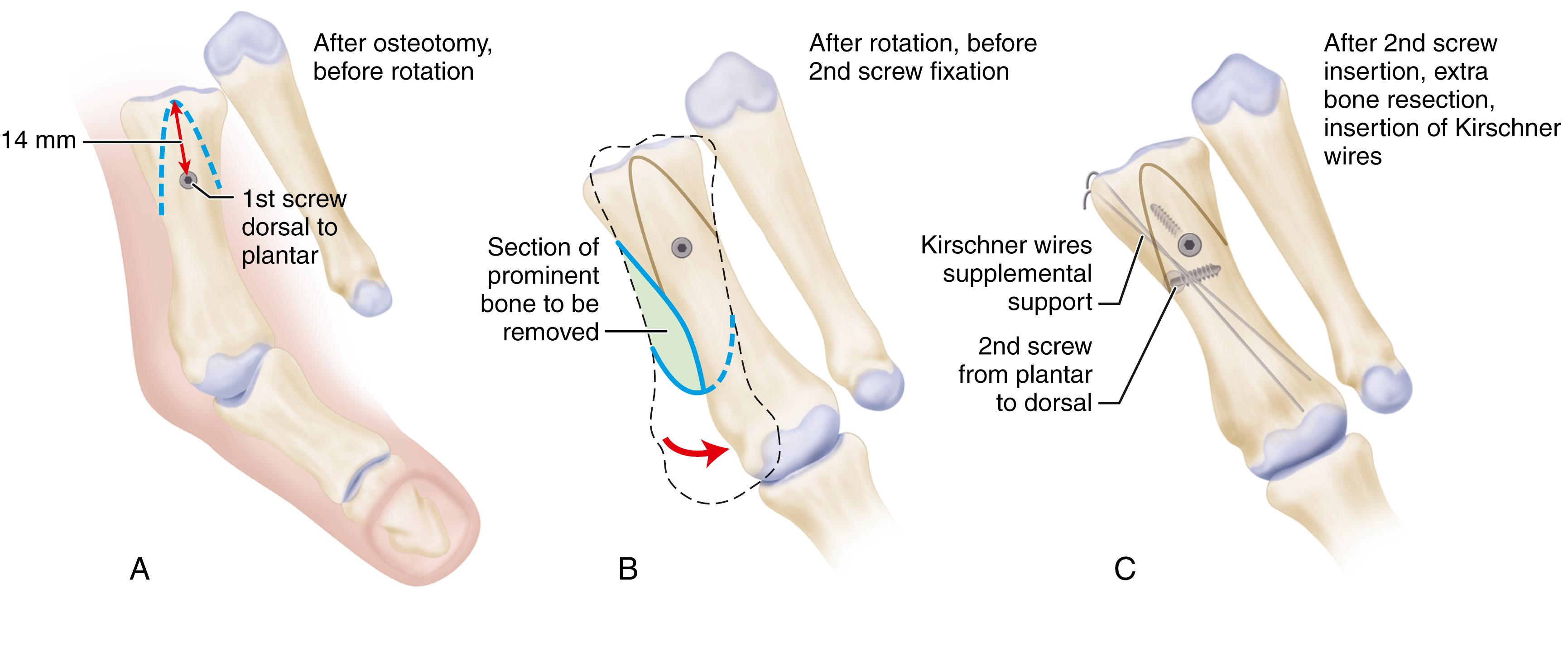 FIGURE 82.55, Ludloff osteotomy. A, Placement of first screw after osteotomy and before rotation of distal fragment. B, Rotation of distal fragment. C, Placement of supplementary Kirschner wires after placement of second screw and resection of bone. (From Schon LC, Dorn KJ, Jung HG: Clinical tip: stabilization of the proximal Ludloff osteotomy, Foot Ankle Int 26:579, 2005.) SEE TECHNIQUE 82.12 .