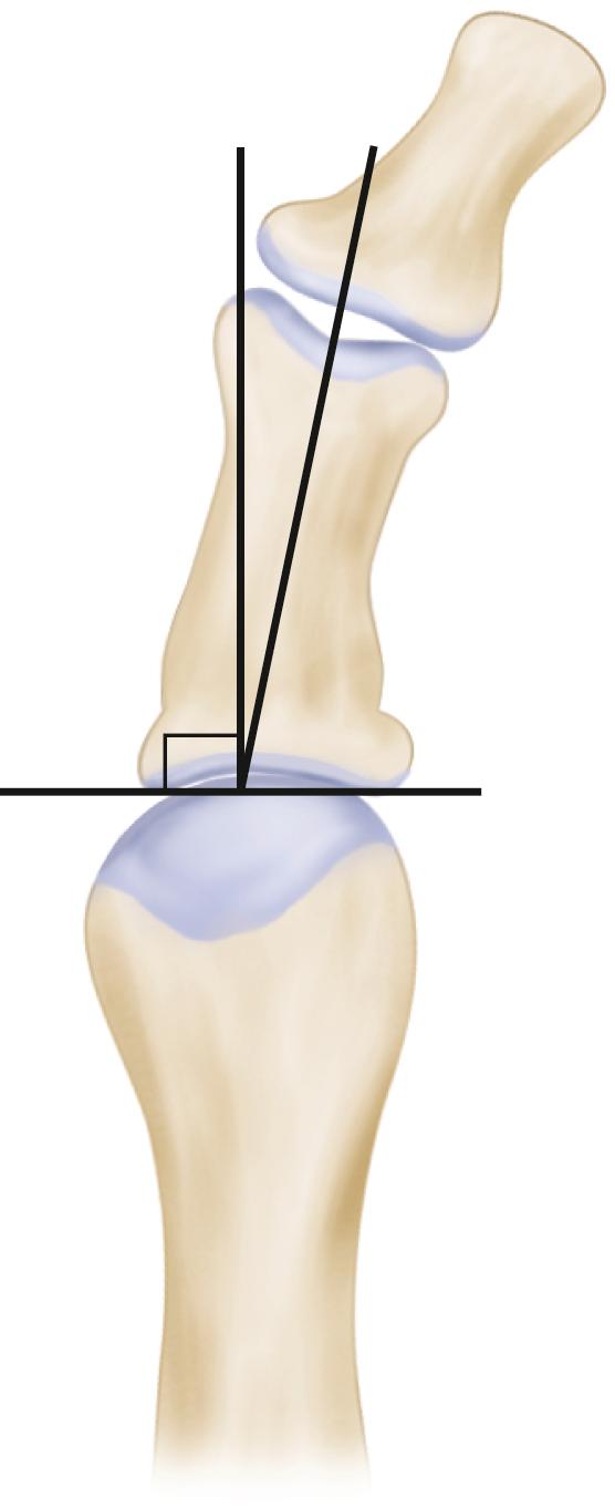 FIGURE 82.6, Proximal phalangeal articular angle.