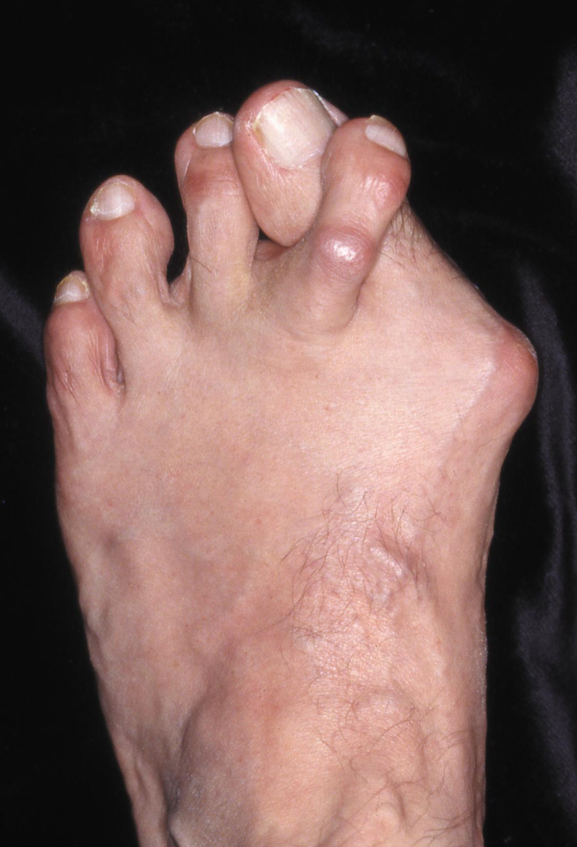 FIGURE 82.7, Hammer toe deformity. Note severe crossover-toe deformity of second toe associated with severe hallux valgus. Primary complaint frequently is not severe hallux valgus deformity but pain beneath second metatarsal head.