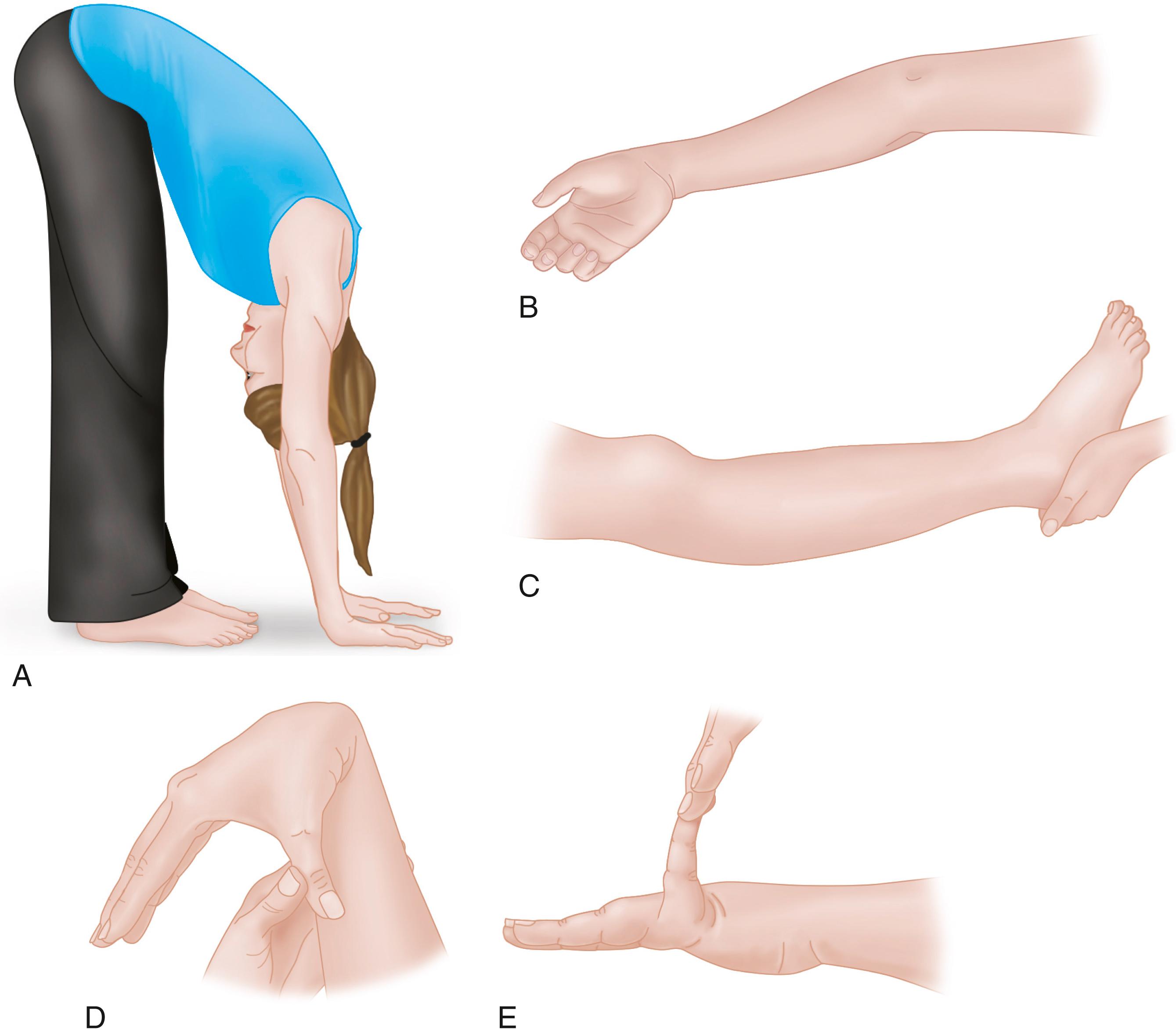 FIGURE 82.9, Beighton score. An answer of yes to two or more indicates hypermobility. A, 1 point if while forward bending and legs straight palms can be placed on ground. B, 1 point for each elbow that can bend backward. C, 1 point for each knee that can bend backward. D, 1 point for each thumb that can touch the forearm when forward bending. E, 1 point for each finger that can bend more than 90 degrees backward.