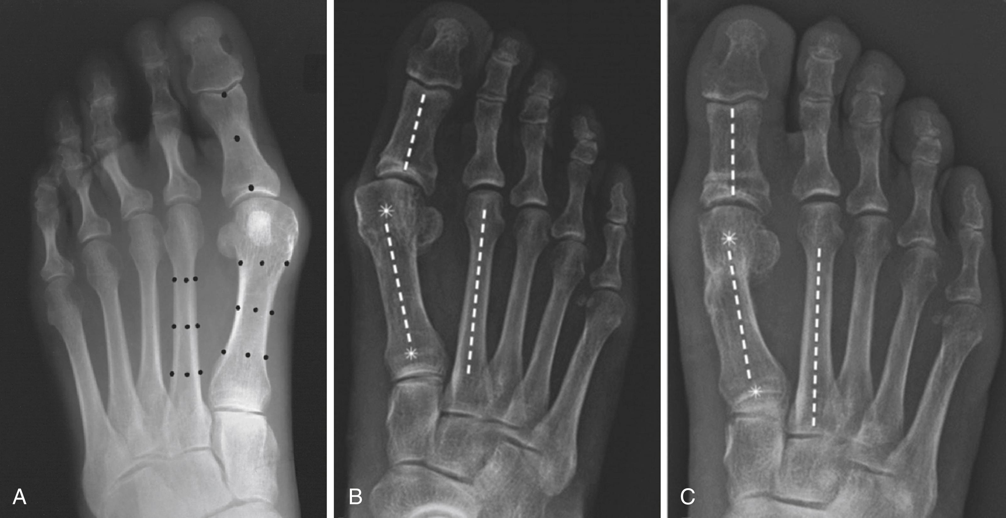 FIGURE 82.10, Method of measuring hallux valgus angle and intermetatarsal angle. A, Center points are connected; if lines are extended, angles are defined. Most current Picture Archiving and Communication Systems (PACS) have functions that determine angles. B and C, Center-head technique of intermetatarsal angle measurement versus preoperative shaft measurement technique.