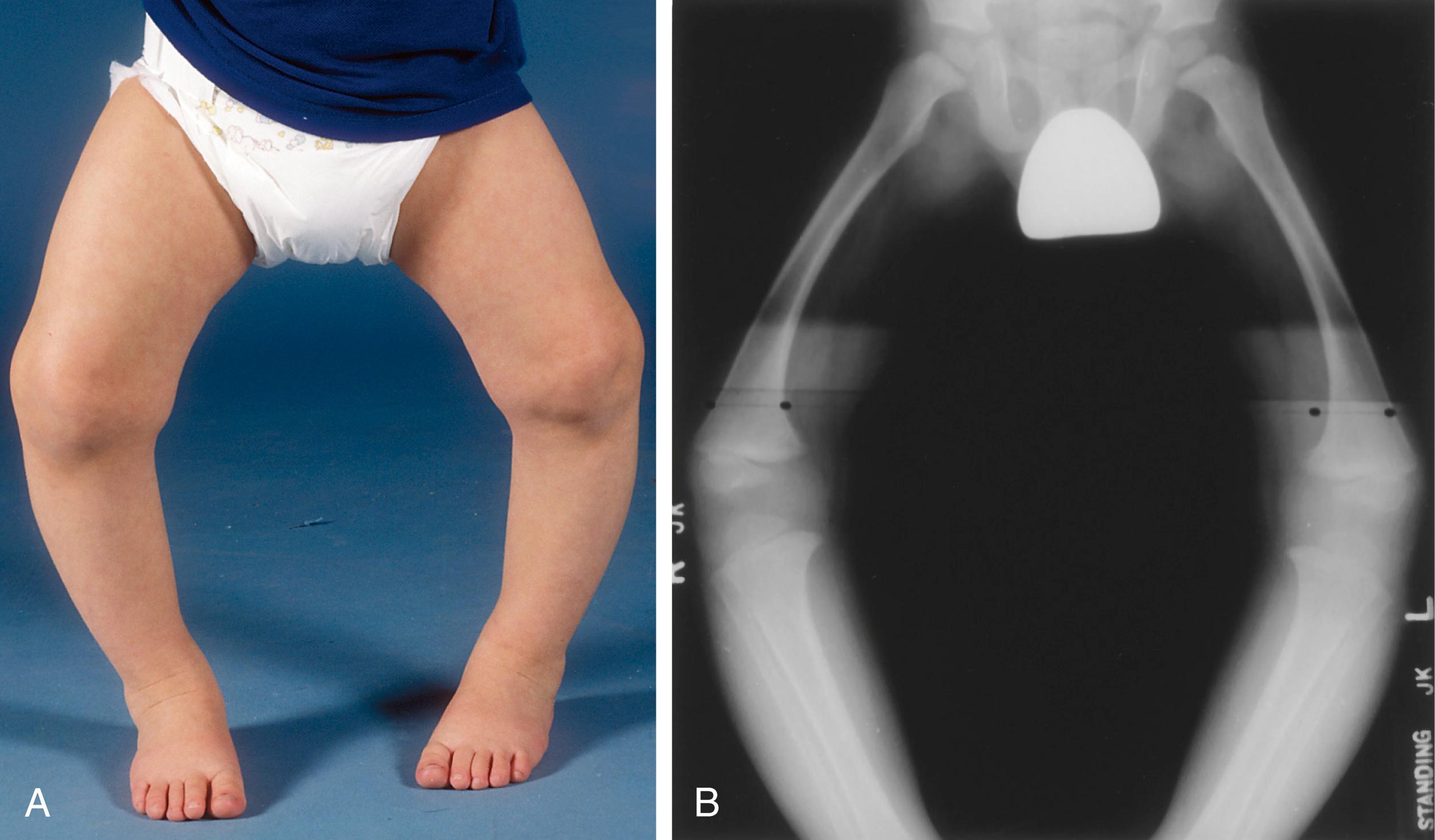 FIG. 18.11, An 18-month-old child with bowlegs. (A) Clinical appearance. Intoeing exacerbates the angulation at the knee. (B) Radiograph showing “delayed” ossification of the medial distal femoral epiphysis and, to a lesser extent, the proximal tibial epiphysis. The physes are normal.