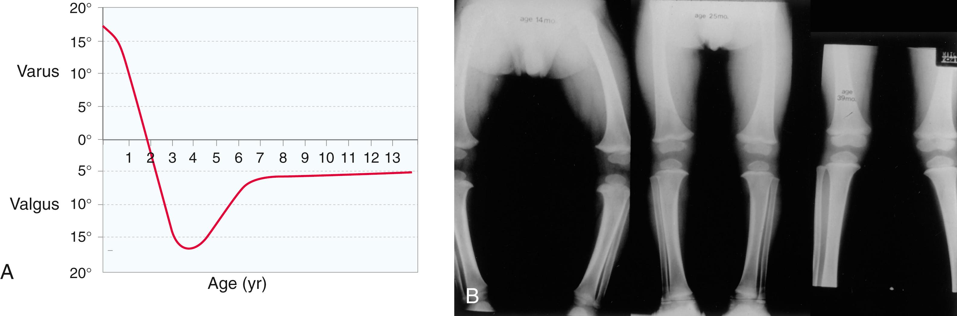 FIG. 18.13, (A) Development of the tibiofemoral angle during growth (after Salenius). (B) Serial radiographs demonstrating normal transition from varus alignment at 14 months to neutral position at 25 months to valgus tibiofemoral alignment at 39 months.