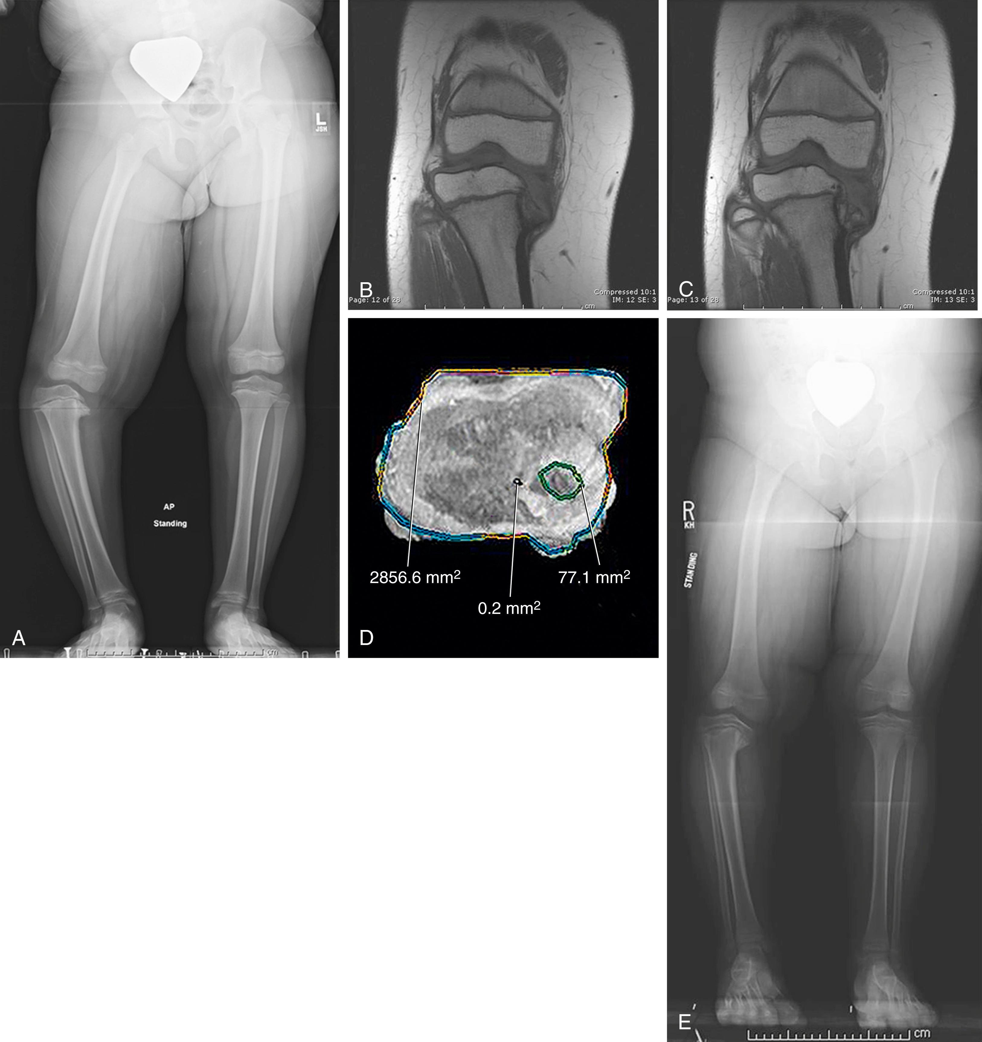 FIG. 18.16, (A) Late-presenting infantile tibia vara (6 years old). Radiograph is concerning for intraarticular deformity or depression of the medial joint line because of irregular ossification. (B) Corresponding coronal magnetic resonance imaging (MRI) of the proximal tibia shows the medial ossification defect of the anterior tibia epiphysis. (C) A more posterior section reveals further defect in the metaphysis. Note the articular surface is maintained by unossified cartilage. (D and E) Axial MRI and corresponding radiograph of a female who is 7 years 11 months old with untreated unilateral disease. The MRI slice through the abnormal physis enabled localization and quantification of the physeal bar (estimated as 6% of the total area in this case). Information was used to guide treatment with bar resection, fat graft interposition, and proximal tibia osteotomy.