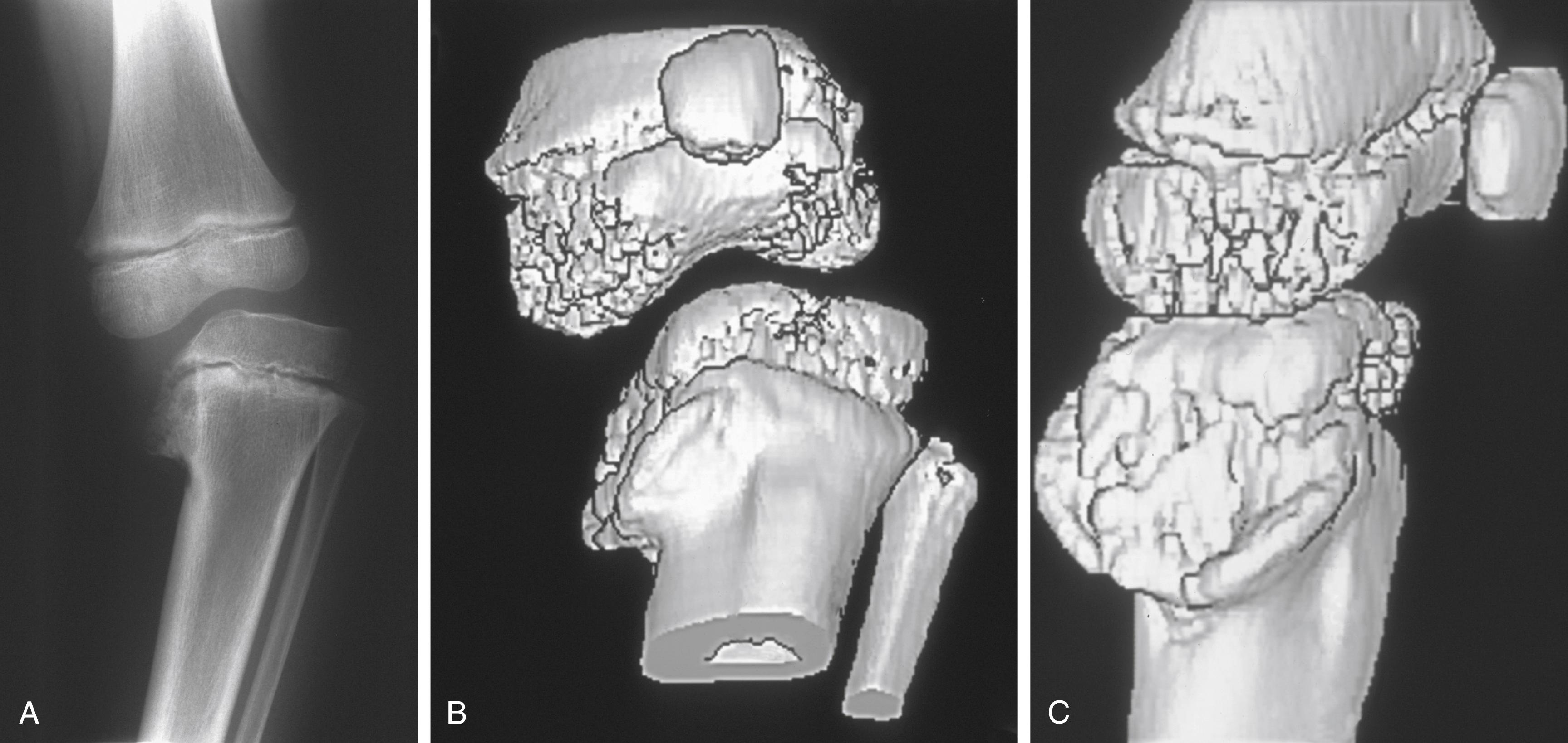 FIG. 18.17, Infantile tibia vara seen at a late age (6 years old). (A) Stage IV lesion previously untreated. (B and C) Three-dimensional computed tomographic reconstruction showing the severe epiphyseal and articular surface depression.