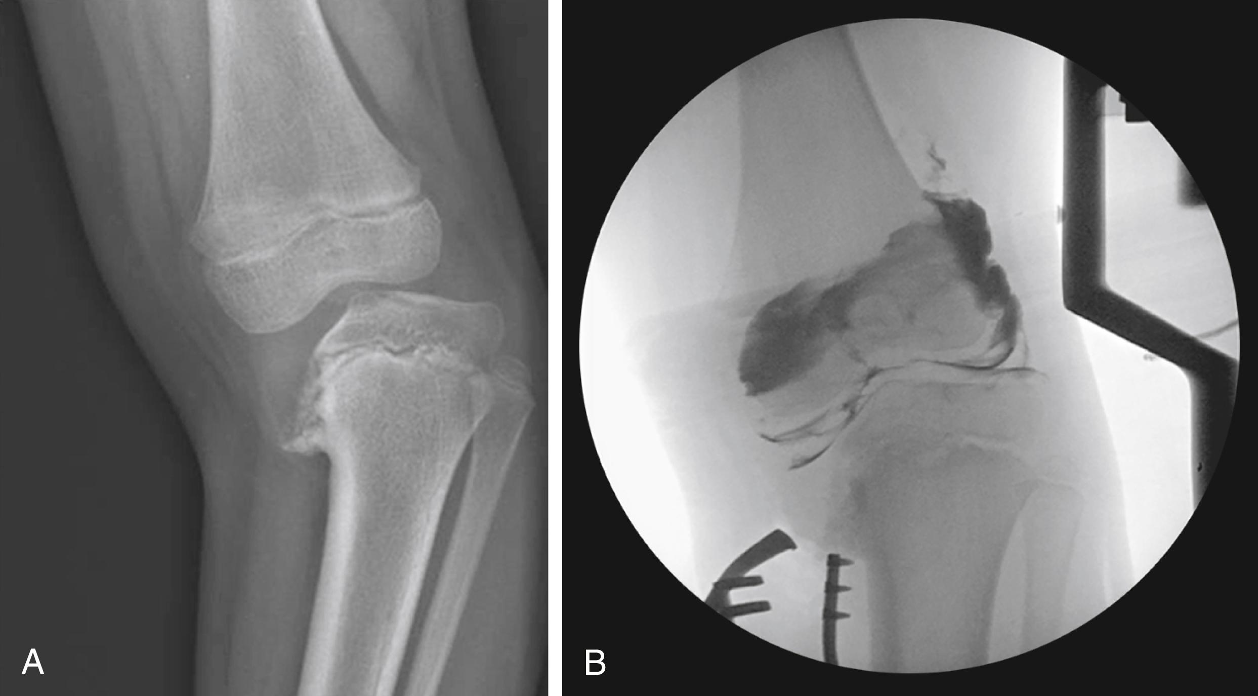 FIG. 18.18, (A) Preoperative knee radiograph showing significant downward sloping of the medial epiphyseal and metaphyseal regions. (B) Intraoperative arthrogram illustrates maintenance of the articular surface despite the abnormal ossification defect obvious on the plain radiograph.