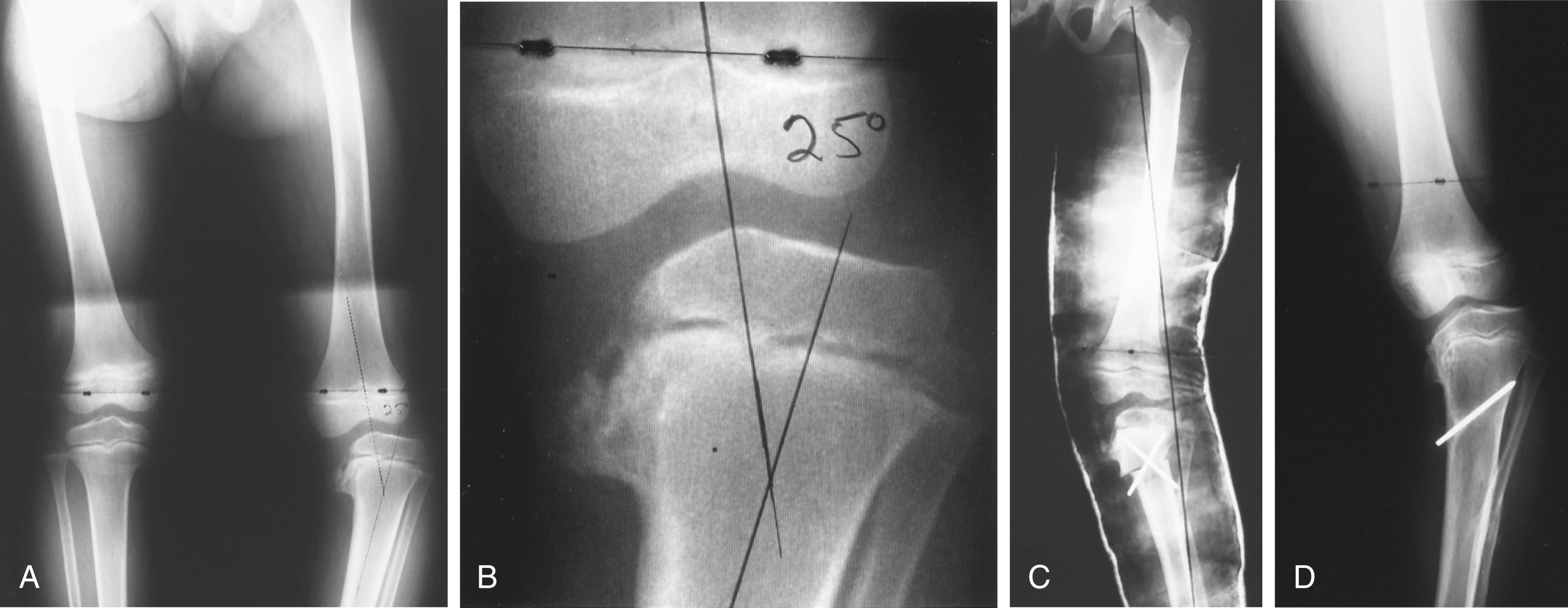 FIG. 18.20, (A) A 5-year-old black girl with a 25-degree varus deformity of the left leg. (B) Close-up view of a stage III lesion (absence of continuous epiphyseal bone sloping into the metaphyseal defect, although the lesion is progressing toward stage IV; see Fig. 18.18 ). (C) Slight valgus overcorrection with lateralization of the mechanical axis produced by a high tibial osteotomy. (D) Radiograph obtained 2 years later showing obvious recurrence and medial physeal arrest (stage VI).