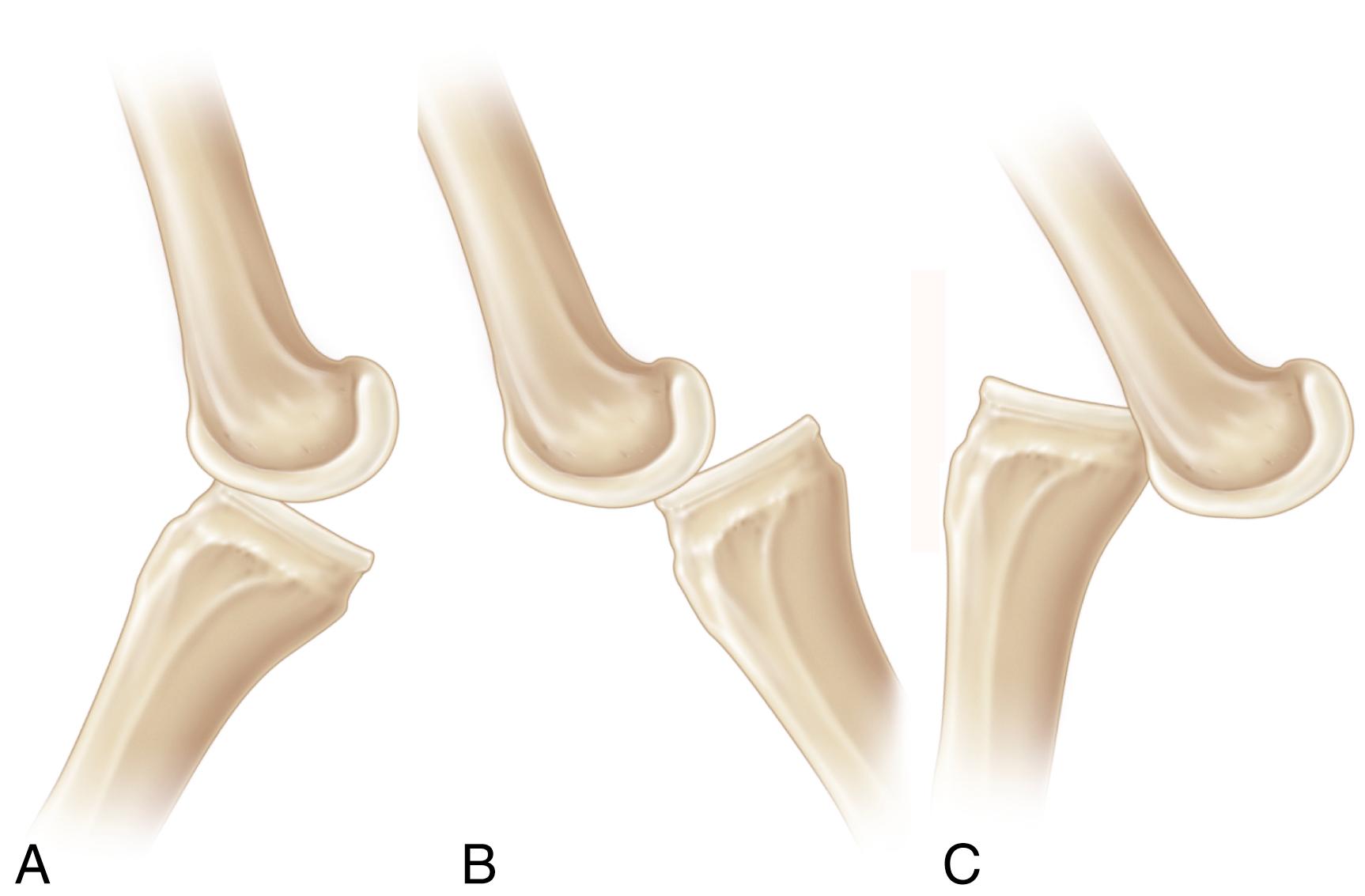 FIG. 18.2, (A) Congenital hyperextension of the knee. (B) Congenital subluxation of the knee. (C) Congenital dislocation of the knee.