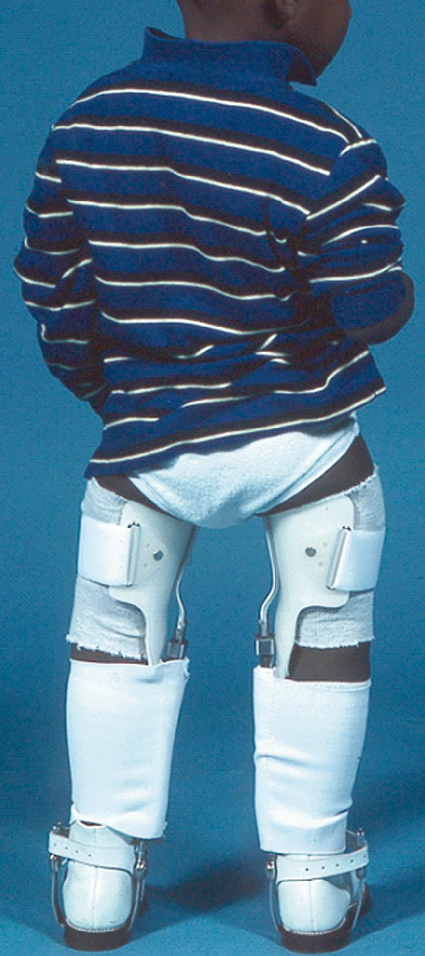 FIG. 18.22, Elastic Blount braces. Note the medial upright with a drop-lock knee hinge that can be locked to increase the effectiveness of valgus pressure during weight bearing.