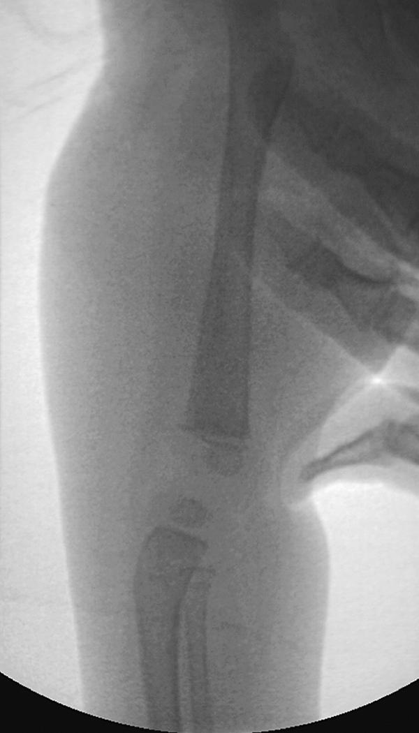 FIG. 18.3, True lateral radiograph of the distal femur and proximal tibia. Note that the femoral condyles are displaced posteriorly on the tibia. Also note the increased angulation of the proximal tibia.