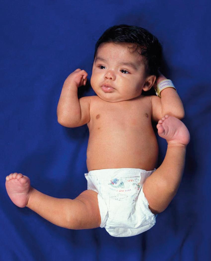 FIG. 18.4, Infant with Larsen syndrome and bilateral dislocated knees, as well as dislocated hips and severe clubfeet.