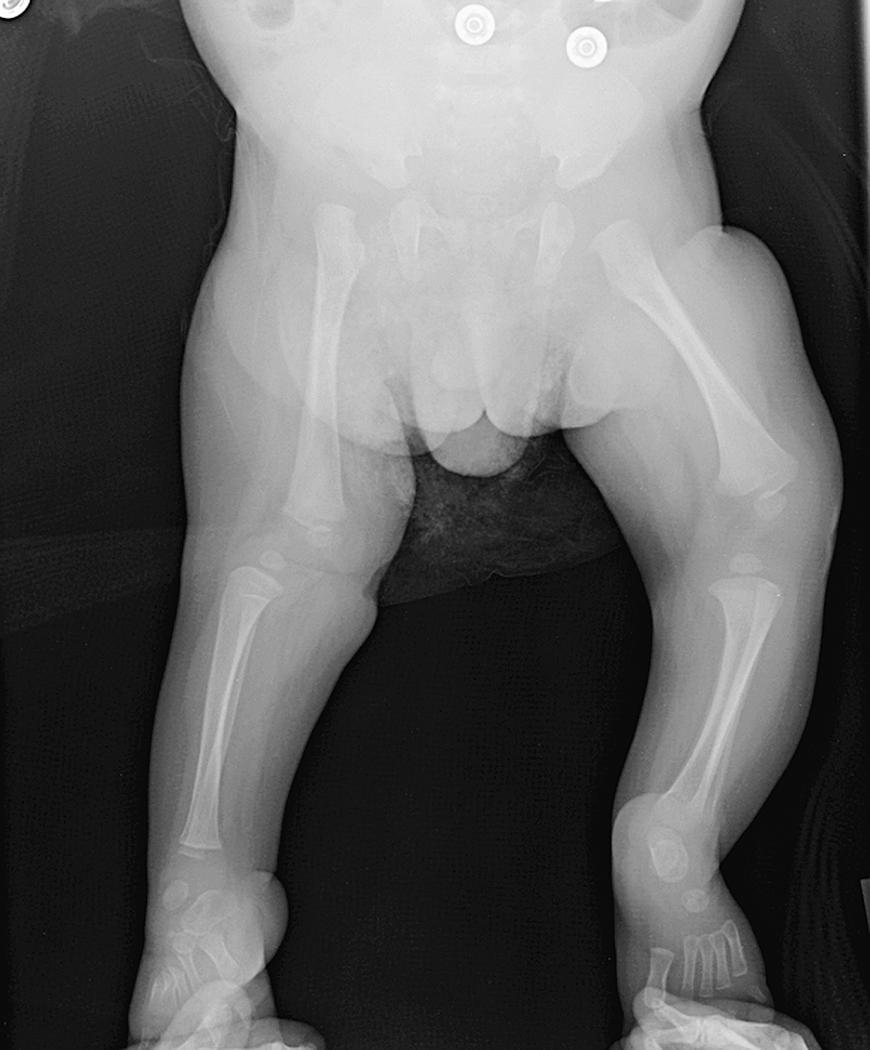 FIG. 18.5, Anteroposterior radiograph of the lower extremities of an infant with a unilateral congenitally dislocated knee. Note the ipsilaterally dislocated hip as well as the severe clubfoot.