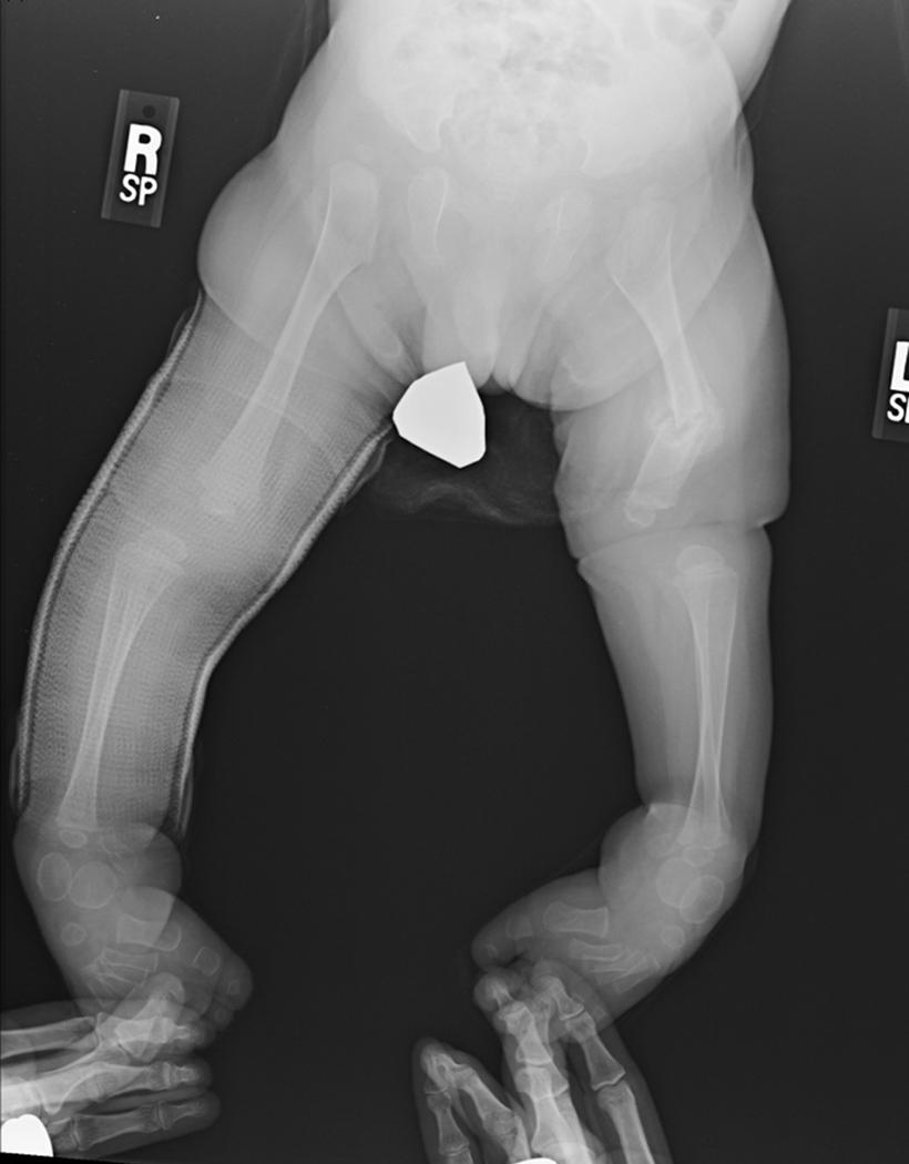 FIG. 18.6, Anteroposterior radiograph of lower extremities of an infant with Larsen syndrome with bilateral knee dislocations who sustained a diaphyseal femur fracture during manipulative treatment of the congenitally dislocated knees. Note the bilateral rotational malalignment and translation of the distal femoral and proximal tibial relationships.