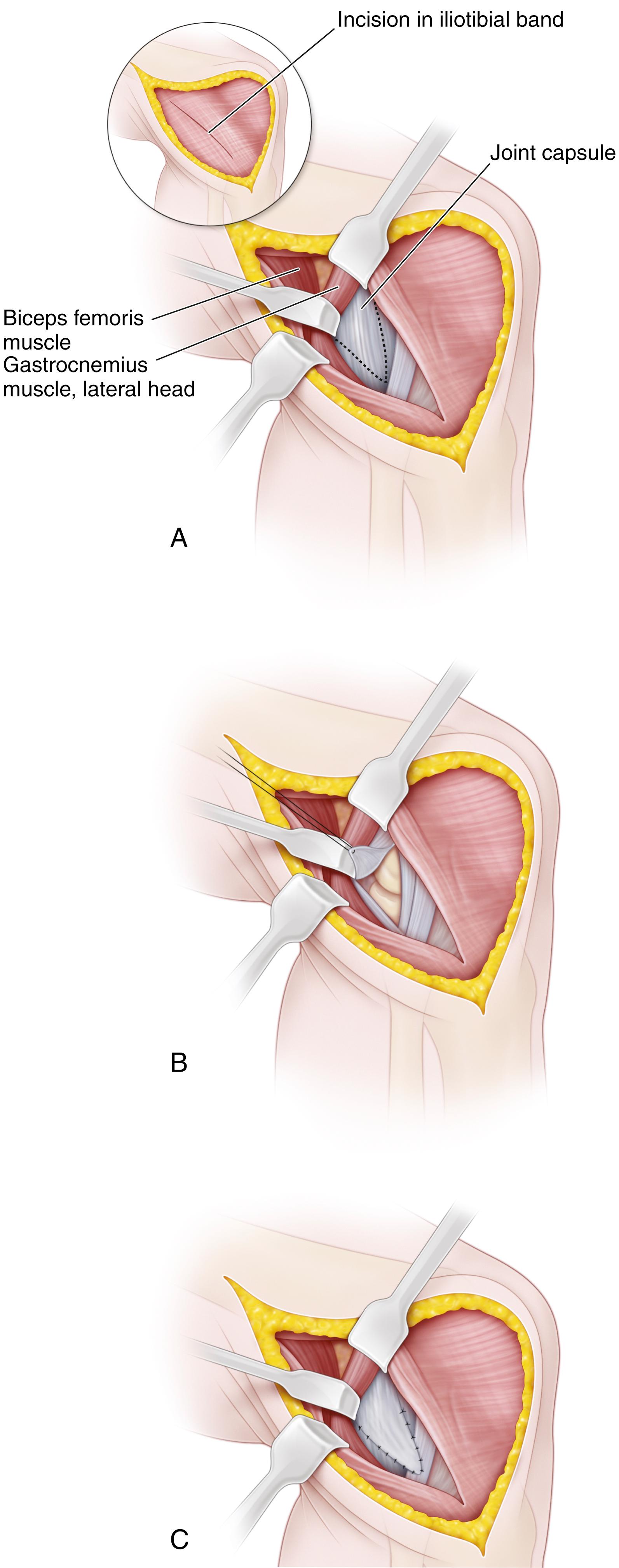 FIG. 18.8, Technique for posterior lateral capsulorrhaphy. (A) Biceps femoris and gastrocnemius are retracted posteriorly and redundant capsule identified. (B) Capsule has been incised and a portion excised. (C) Distal capsule has been advanced in a “pants-over-vest” fashion.