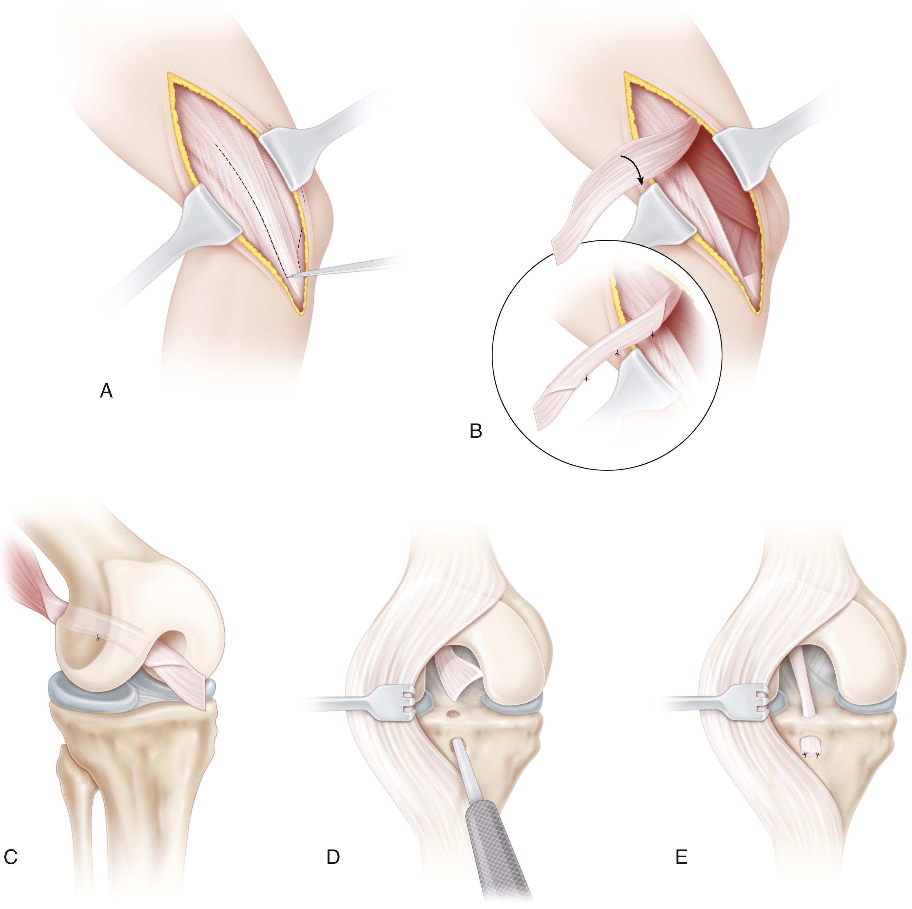 FIG. 18.9, Surgical technique for iliotibial (IT) band transfer for anterior cruciate ligament deficiency. (A) Skin and tendon incisions. (B) The anterior portion of the IT band is mobilized and “tubularized.” (C) The tendon is passed “over the top” and through the intercondylar notch. (D) A tunnel is made entirely within the epiphysis, with care to avoid damage to the physis. (E) The tendon is passed through the tunnel and secured with sutures.