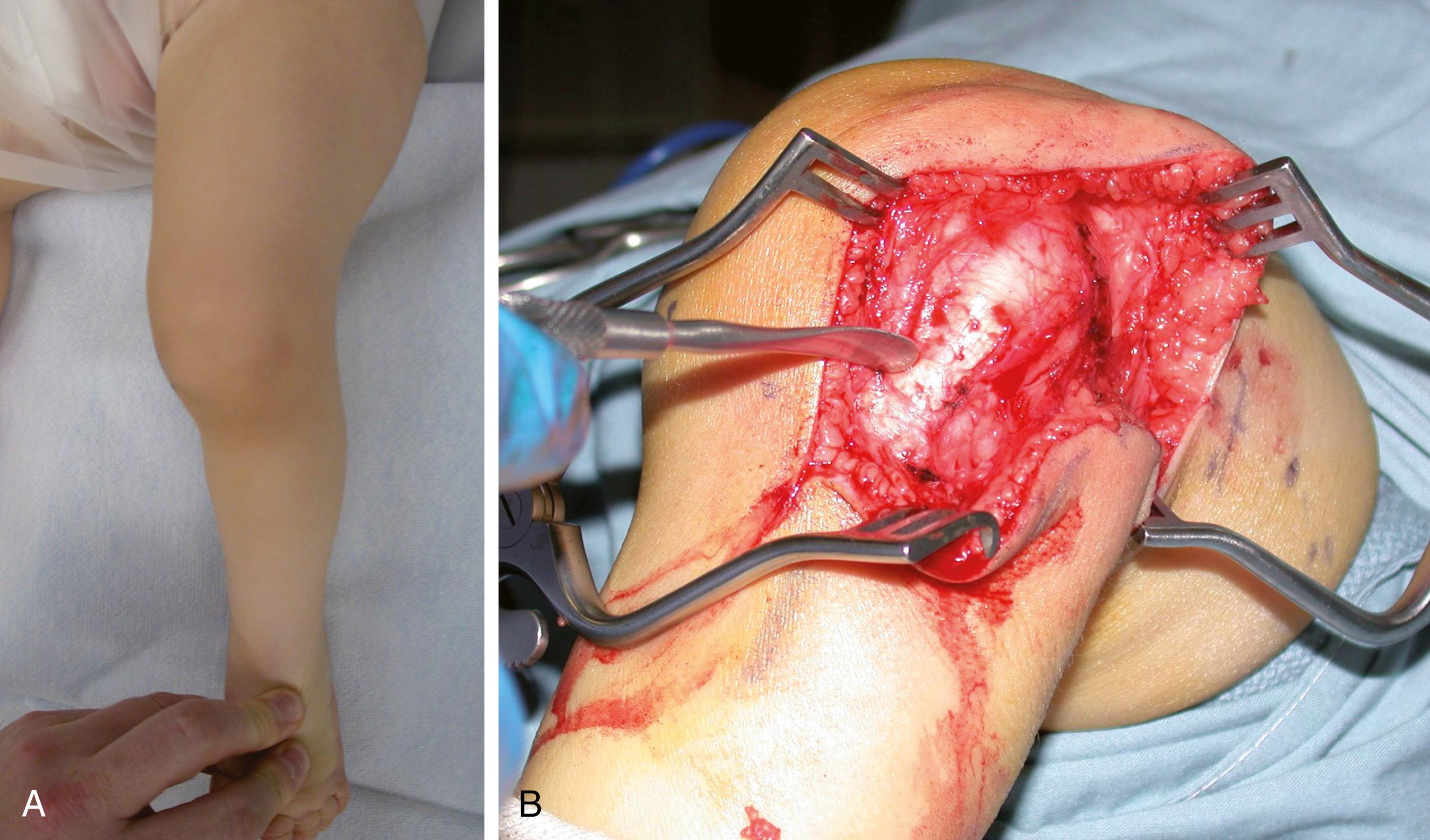 FIG. 18.10, (A) Clinical appearance of a child with congenitally dislocated patella. Note the knee flexion and slight valgus appearance. (B) Intraoperative photograph showing displacement of the patella and patellar tendon.