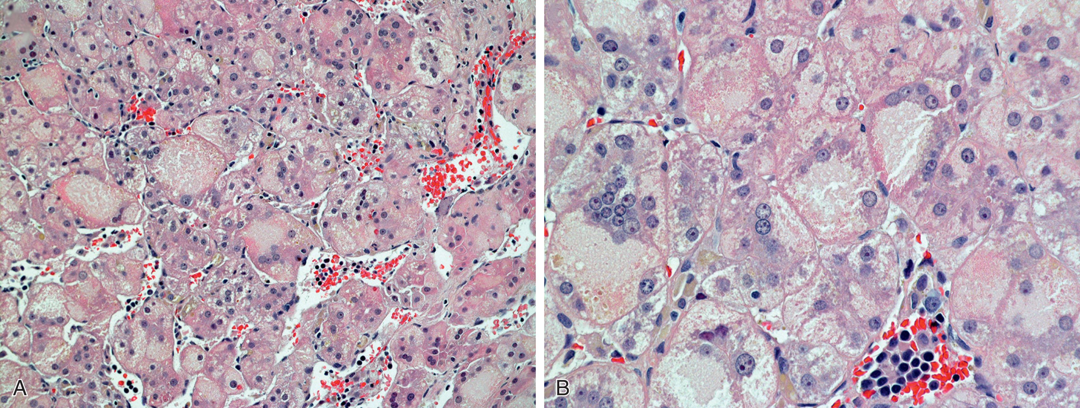 Fig. 65.2, Neonatal Hepatitis Histology.