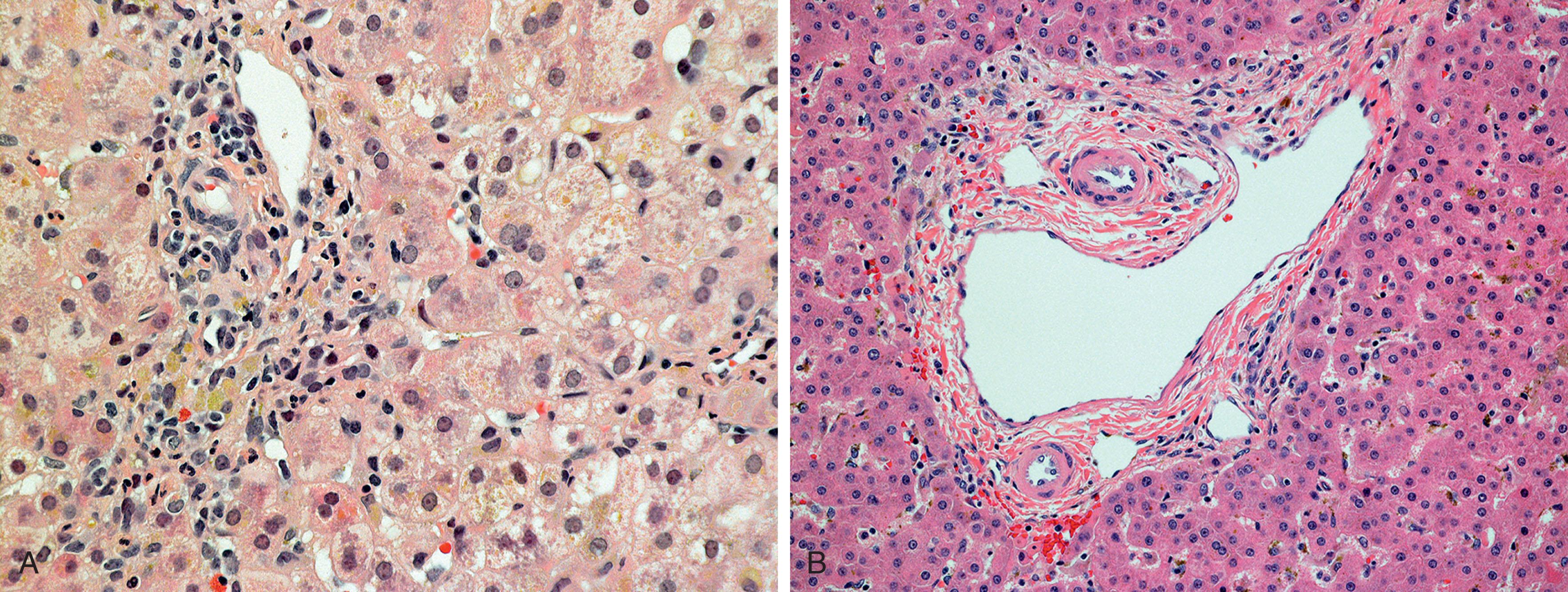 Fig. 65.4, Alagille Syndrome Histology.