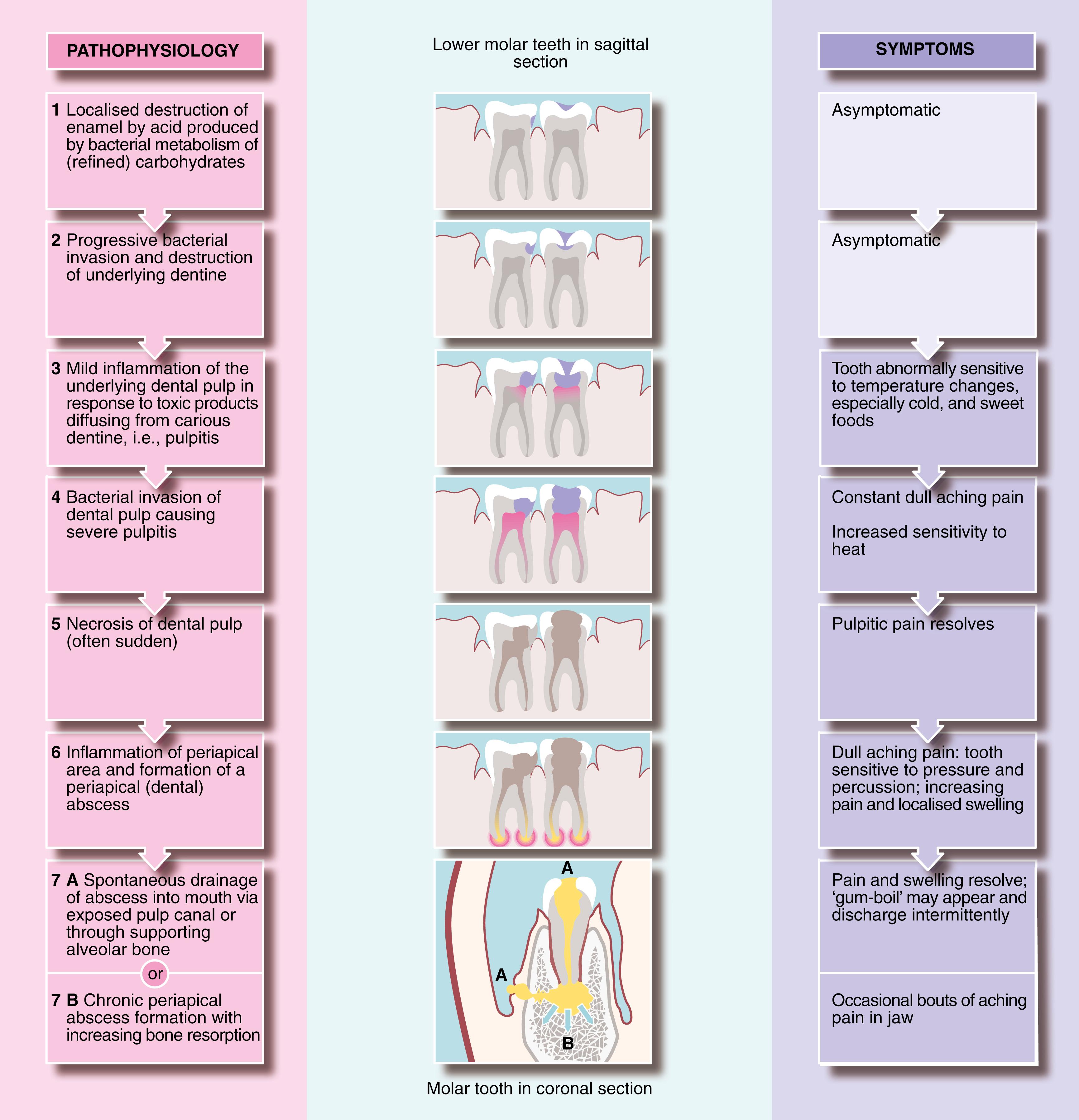 Fig. 48.1, Pathophysiology and Symptoms of Dental Caries and Its Sequelae.