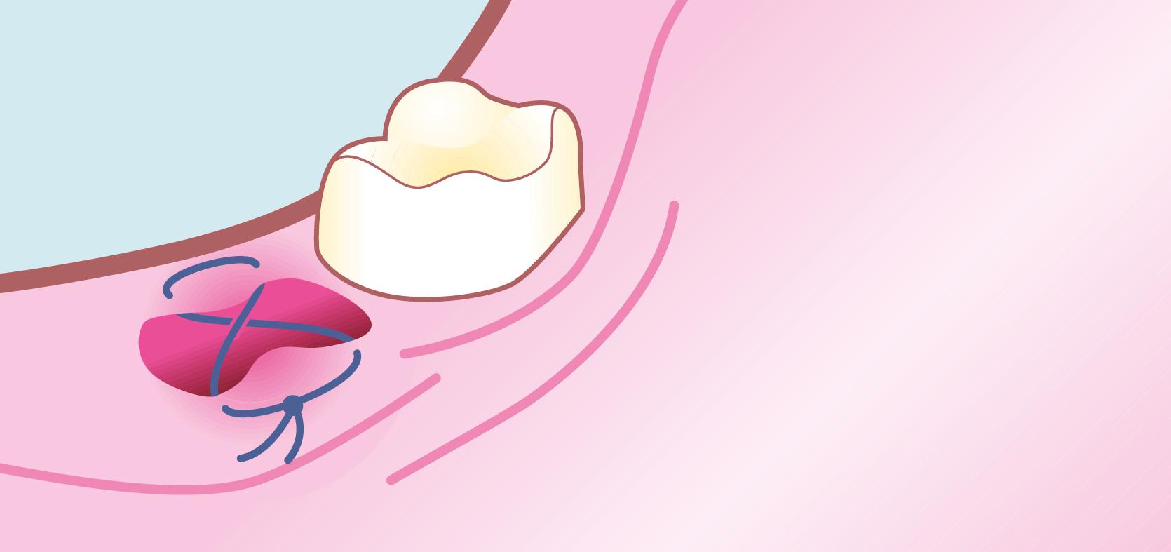 Fig. 48.3, Suture Technique for Arresting Bleeding from a Tooth Socket.