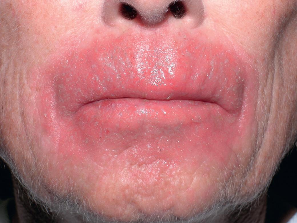 Fig. 34.1, Allergic contact cheilitis to topical steroids.