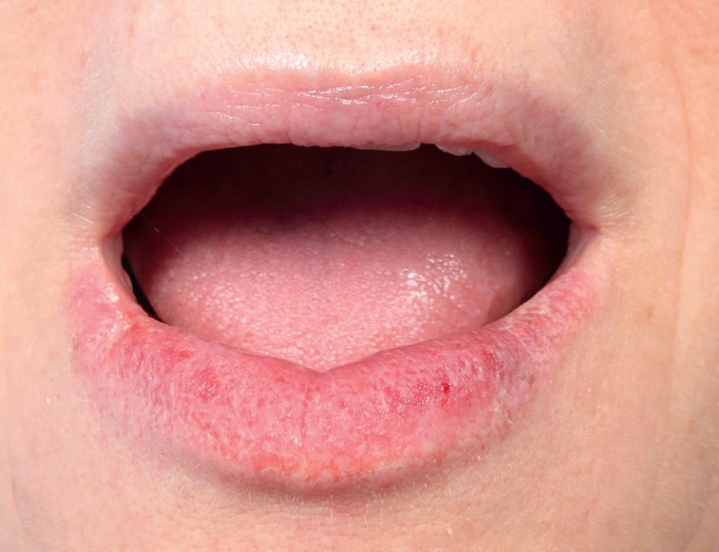 Fig. 34.2, Actinic cheilitis.