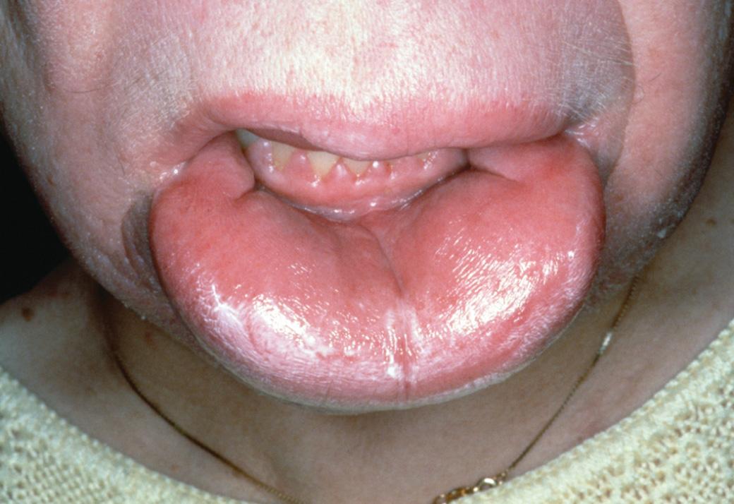 Fig. 34.6, Melkersson-Rosenthal syndrome.