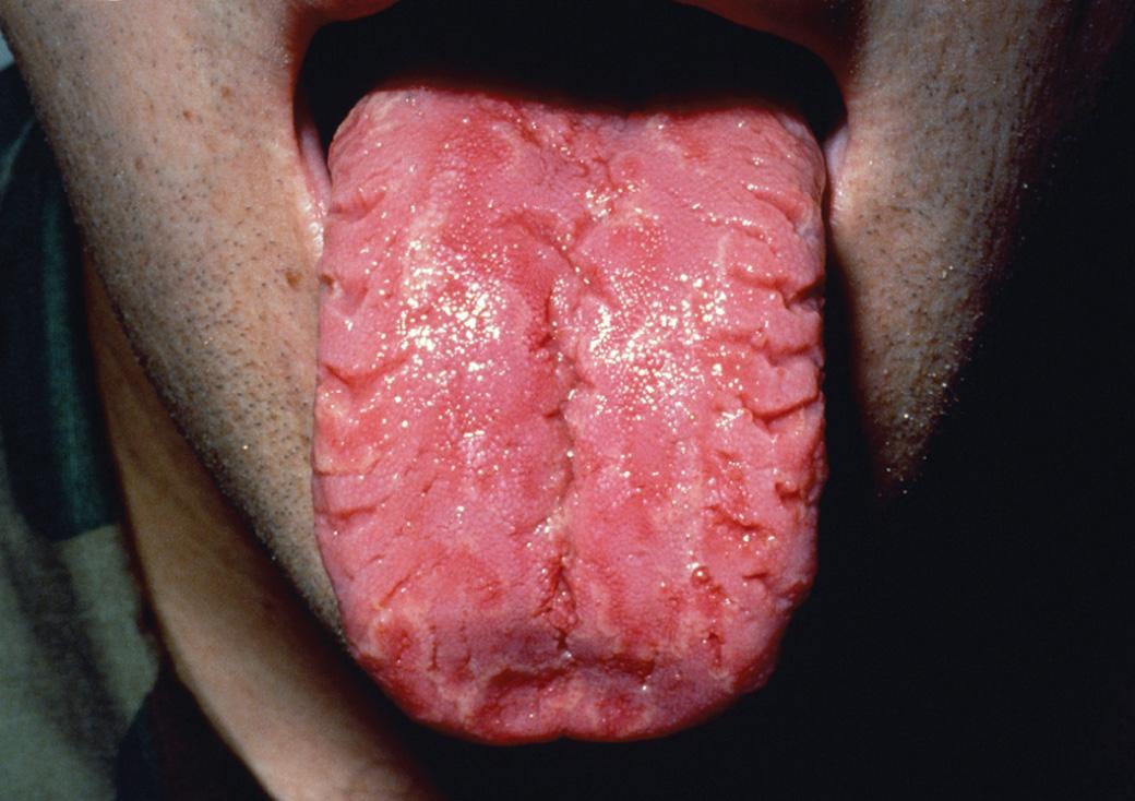 Fig. 34.7, Fissured tongue.