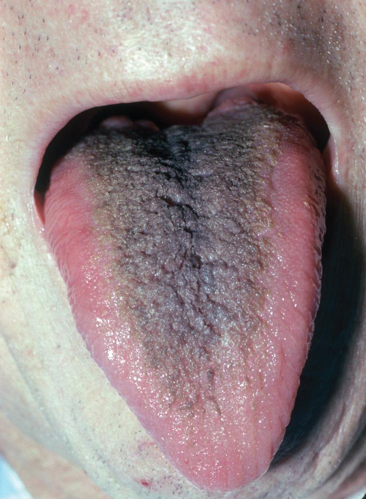 Fig. 34.9, Black hairy tongue.