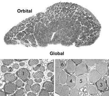 Figure 46.2, Light photomicrographs of monkey lateral rectus muscle. Top: Low-magnification cross-section of the muscle indicating orbital and global muscle layers. The orbital layer extends around much of the perimeter of the muscle, whereas larger fibers in the global layer fill the central portion of the muscle. Bottom: ( Left ) High-magnification micrograph of the orbital layer illustrating (1) orbital singly innervated and (2) orbital multiply innervated fiber types. ( Right ) High-magnification micrograph of the global layer illustrating the (3) global red singly innervated, (4) global intermediate singly innervated, (5) global white singly innervated, and (6) global multiply innervated fiber types. Original magnification ×21 (Top), ×410 (L and R).