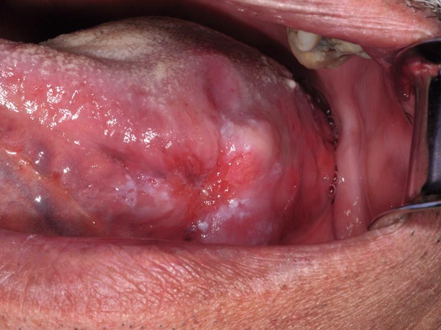 Fig. 62.1, Ulcerated exophytic squamous cell carcinoma of the midlateral tongue.