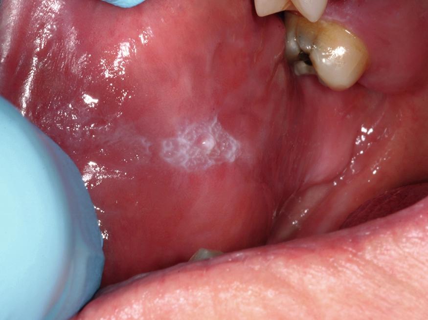 Fig. 62.2, Proliferative verrucous leukoplakia of the buccal mucosa. Note the white corrugated basket weave–like pattern.