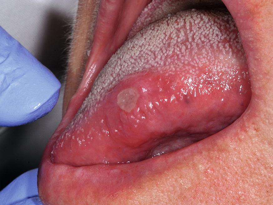 Fig. 62.3, Minor aphthous ulcer of the tongue. The solitary ulcer is covered by yellow proteinaceous debris and marginated by erythema.