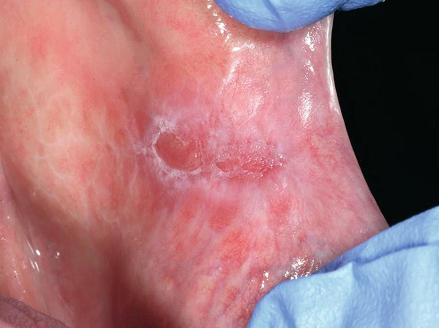 Fig. 62.4, Ulcerative lichen planus of the buccal mucosa. Note the typical radiating striated lichenoid pattern of hyperkeratosis at the margins of the ulcer.