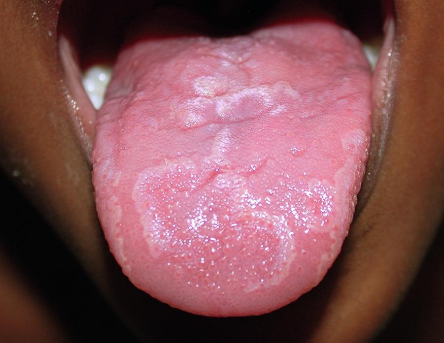 Fig. 62.5, Geographic tongue demonstrating well-demarcated zones of desquamation that are marginated by a white border.