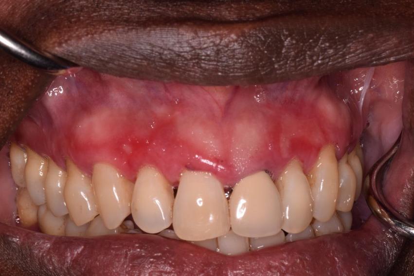 Fig. 62.6, Diffuse generalized erythematous gingiva with erosions characterizes benign mucous membrane pemphigoid.