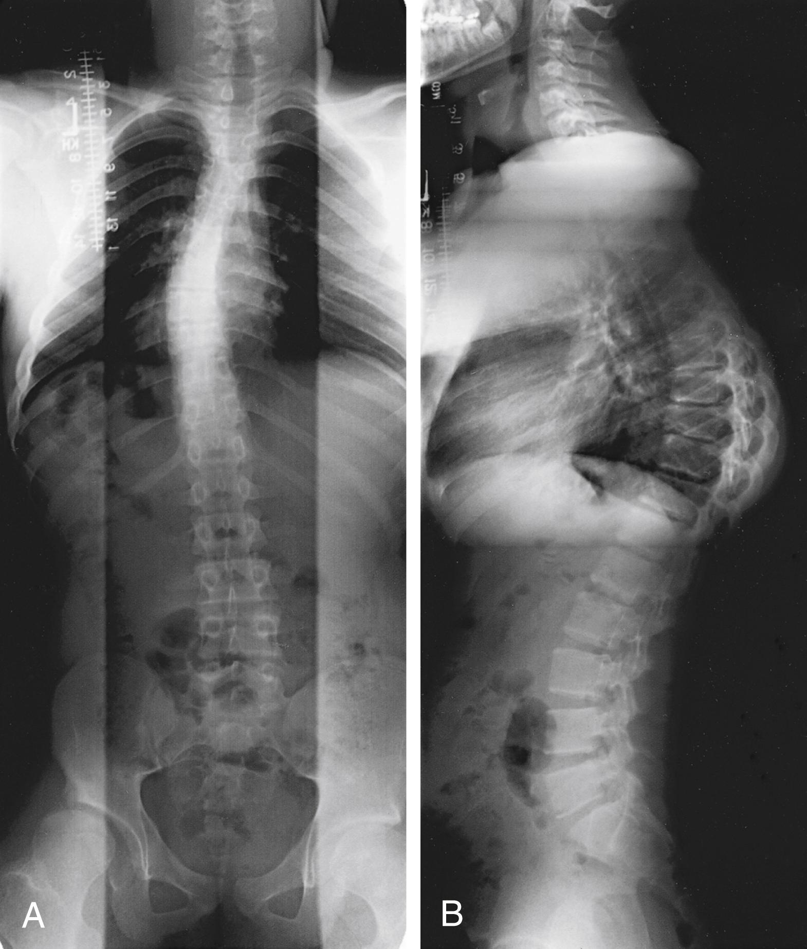 FIG. 34.11, Scoliosis in a 14-year-old with Charcot-Marie-Tooth disease. (A) Anteroposterior view. (B) Lateral view demonstrates increased thoracic kyphosis.