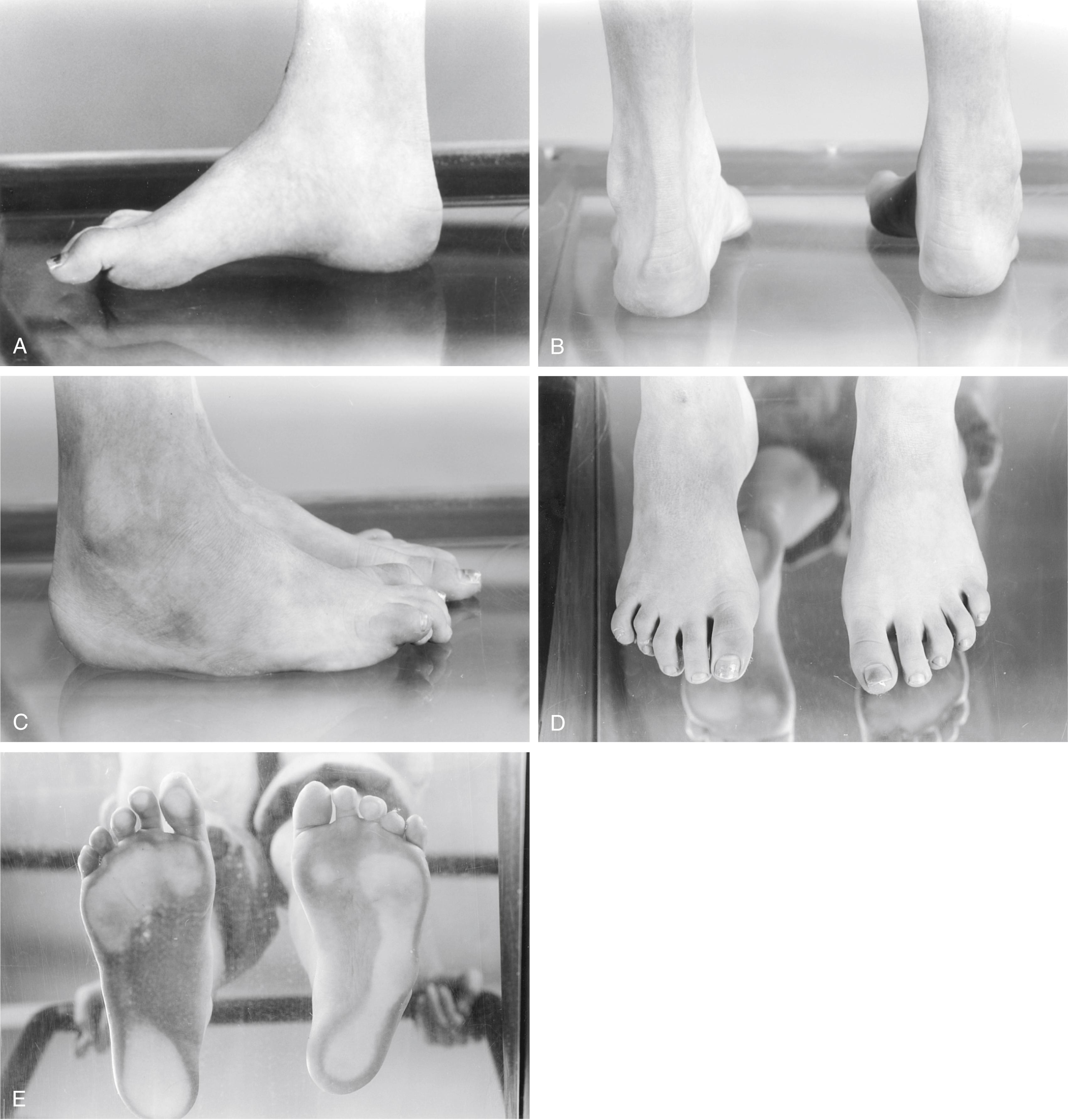 FIG. 34.3, Pes cavovarus in a 12-year-old girl with Charcot-Marie-Tooth disease. (A) The longitudinal arch of the foot is elevated, and there is clawing of the great toe (hyperextension of the metatarsophalangeal joint and flexion of the interphalangeal joint). (B) Hindfoot varus of the right foot is apparent. (C) A callus is present over the base of the fifth metatarsal. (D) Clawing of the lesser toes is present bilaterally. (E) Pressure is abnormally distributed, with excess loading along the lateral border of the foot, on the first metatarsal head, and on the tips of the claw toes.