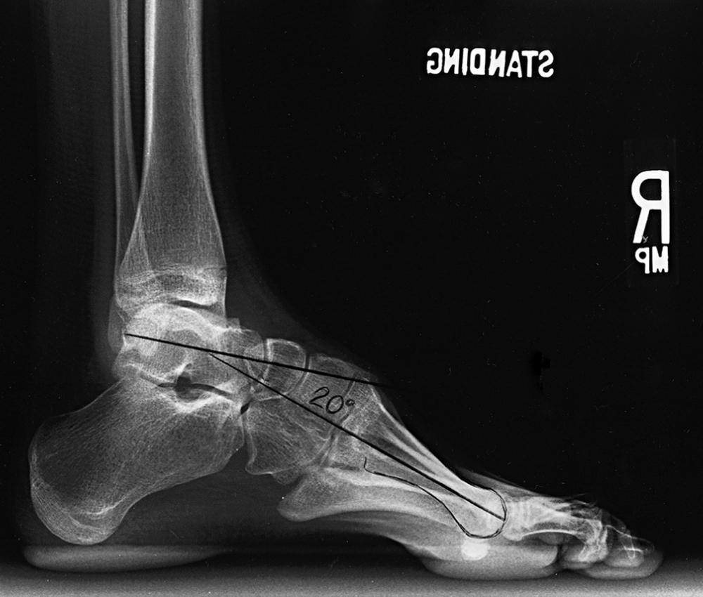 FIG. 34.4, Standing lateral radiograph of the foot of a 14-year-old girl with Charcot-Marie-Tooth disease and cavovarus deformity. The Meary angle is increased (20 degrees) and there is parallelism of the talus and calcaneus, demonstrated by the ability to “see through” the subtalar joint. The calcaneus is dorsiflexed relative to the tibia.