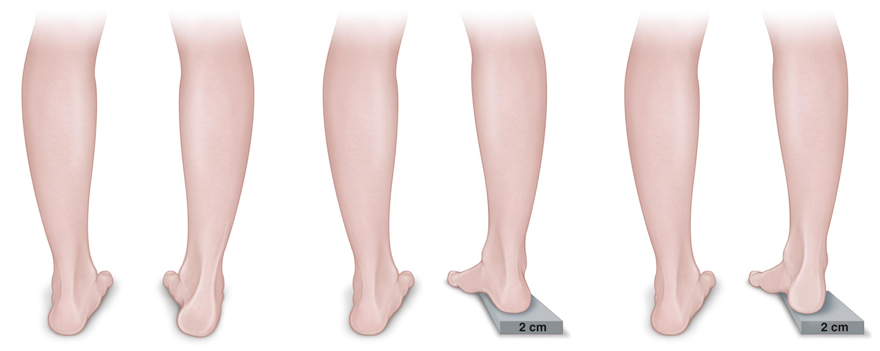 FIG. 34.5, Coleman block test. The heel of the foot and lateral border are placed on a wooden block, allowing the head of the first metatarsal to drop into plantar flexion. If the hindfoot varus is secondary to the tripod effect of the plantar flexed first ray, the hindfoot will correct to neutral or valgus alignment (middle). If the hindfoot varus is rigid, it will not correct (right) .